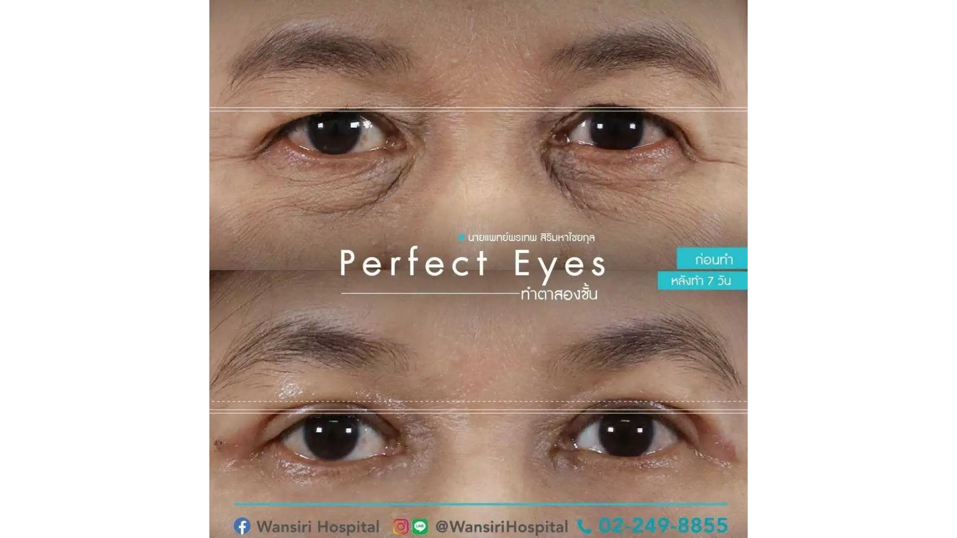 Epicanthoplasty in Bangkok, Thailand by Wansiri Hospital