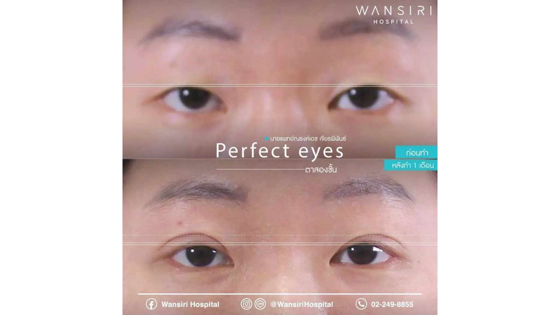 Epicanthoplasty in Bangkok, Thailand by Wansiri Hospital
