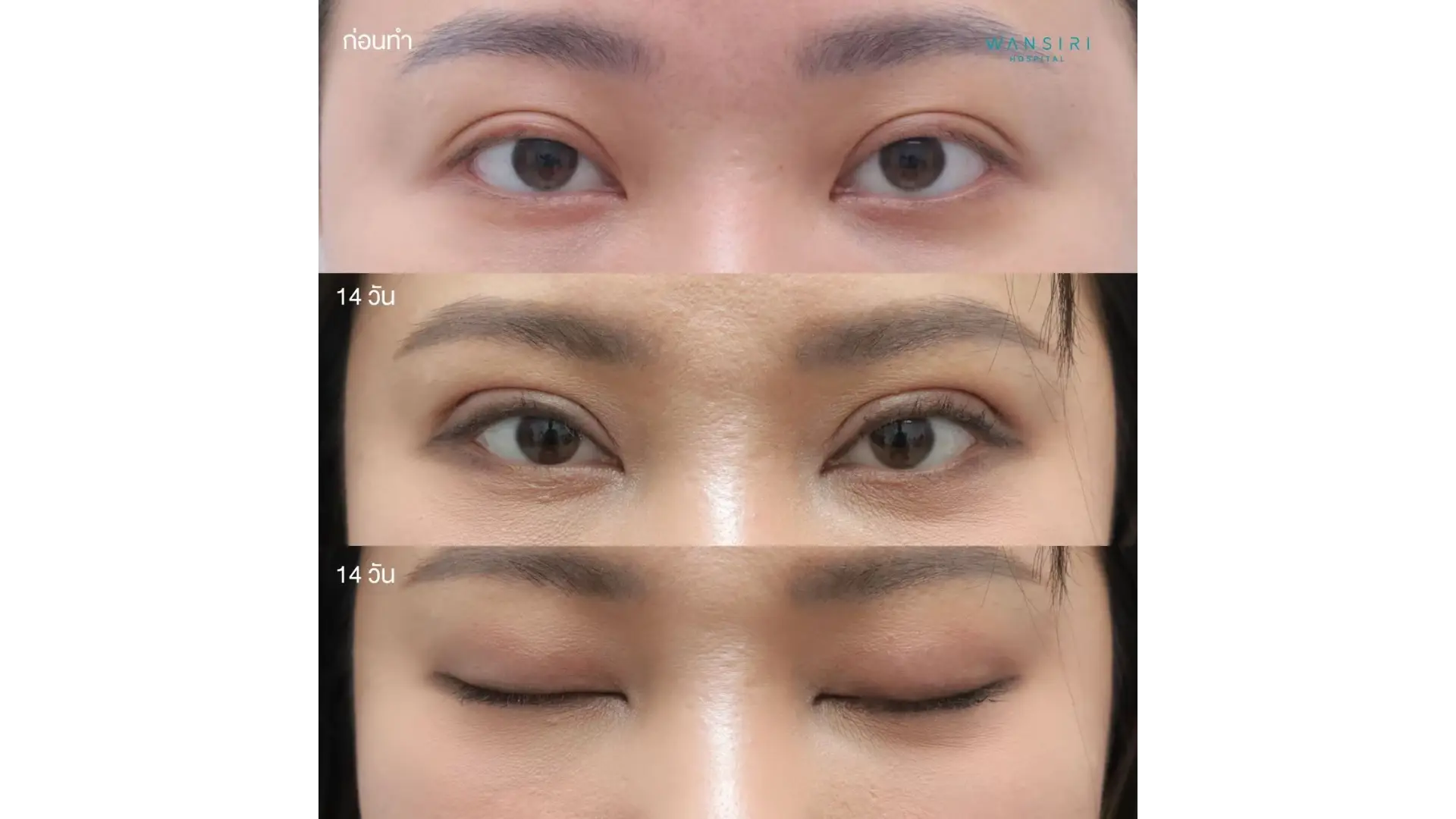 Epicanthoplasty in Bangkok, Thailand by Wansiri Hospital