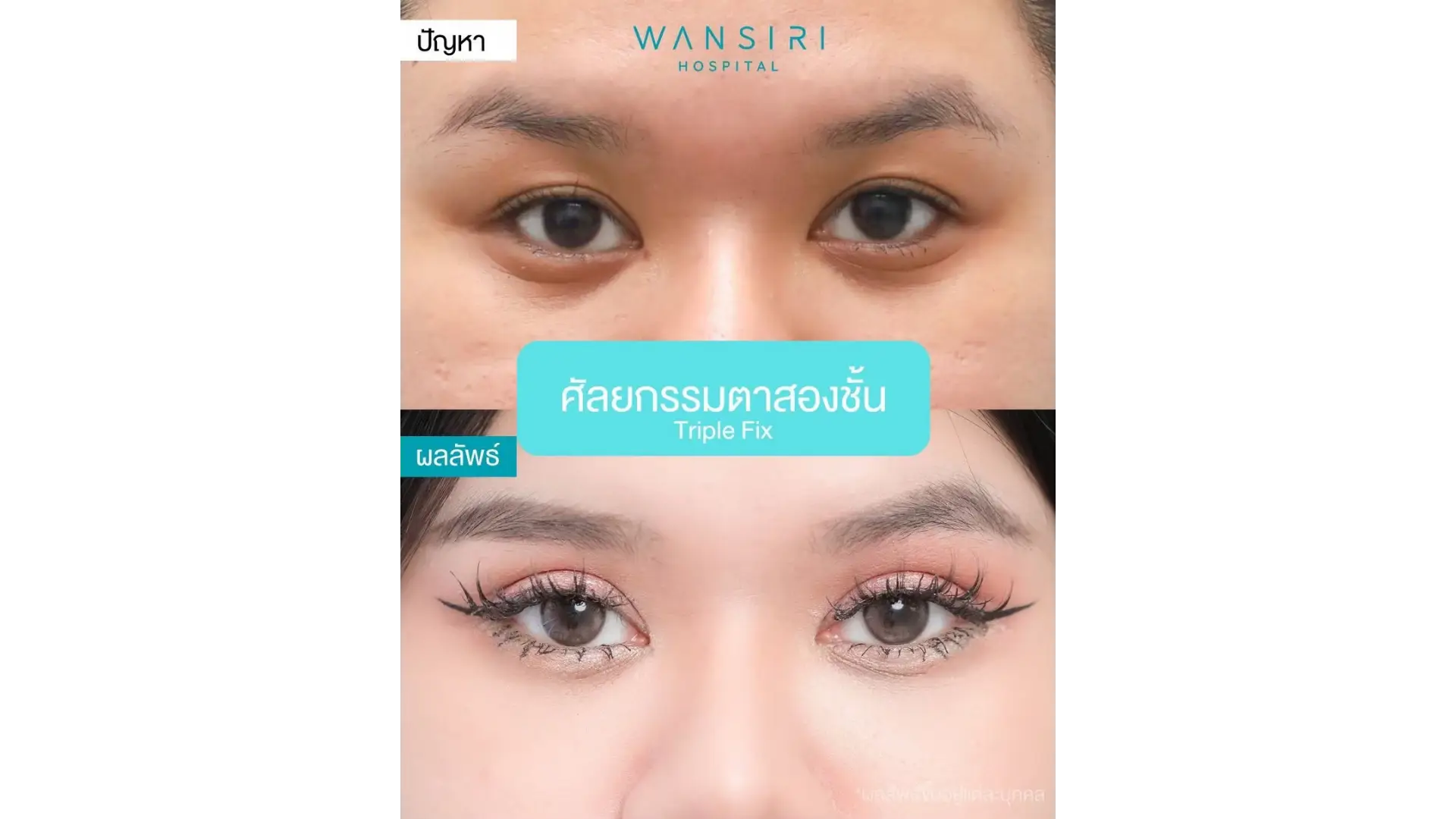 Blepharoplasty in Bangkok, Thailand by Wansiri Hospital