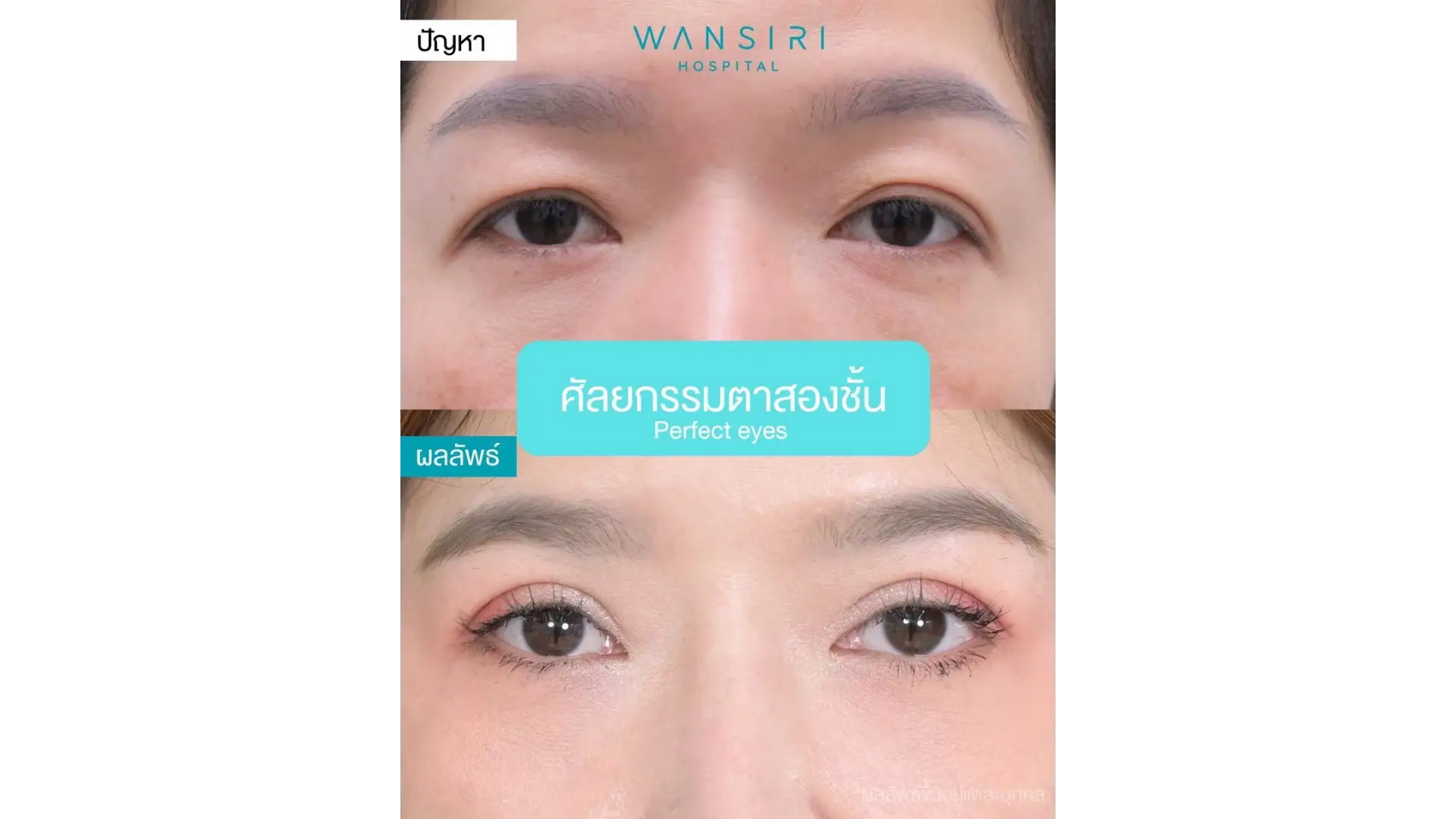 Epicanthoplasty in Bangkok, Thailand by Wansiri Hospital