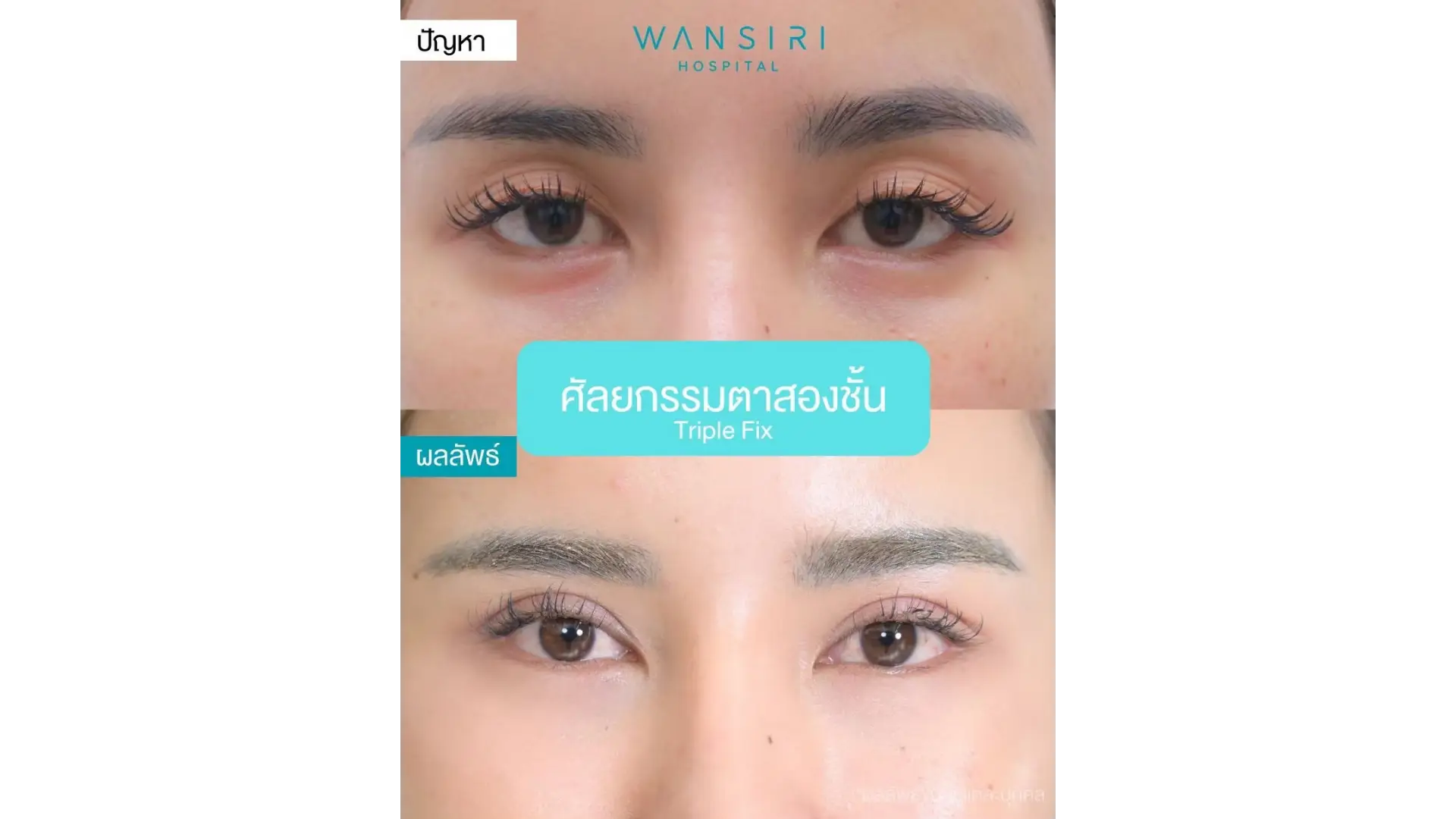 Blepharoplasty in Bangkok, Thailand by Wansiri Hospital