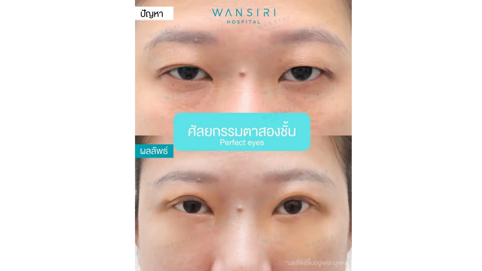 Epicanthoplasty in Bangkok, Thailand by Wansiri Hospital