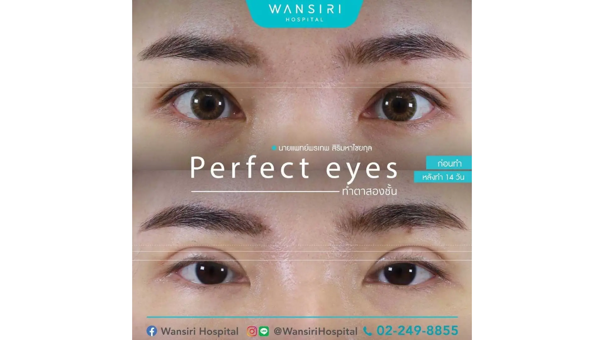 Blepharoplasty in Bangkok, Thailand by Wansiri Hospital