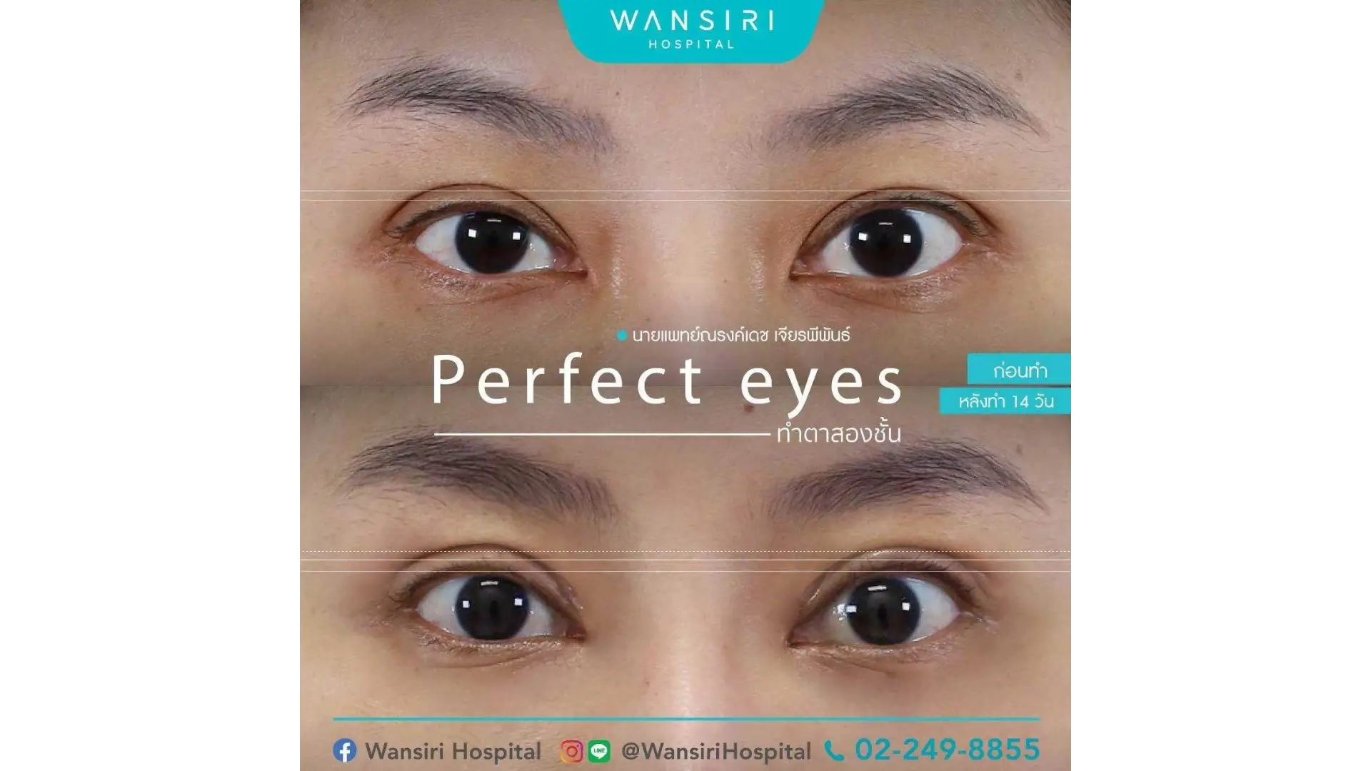 Blepharoplasty in Bangkok, Thailand by Wansiri Hospital