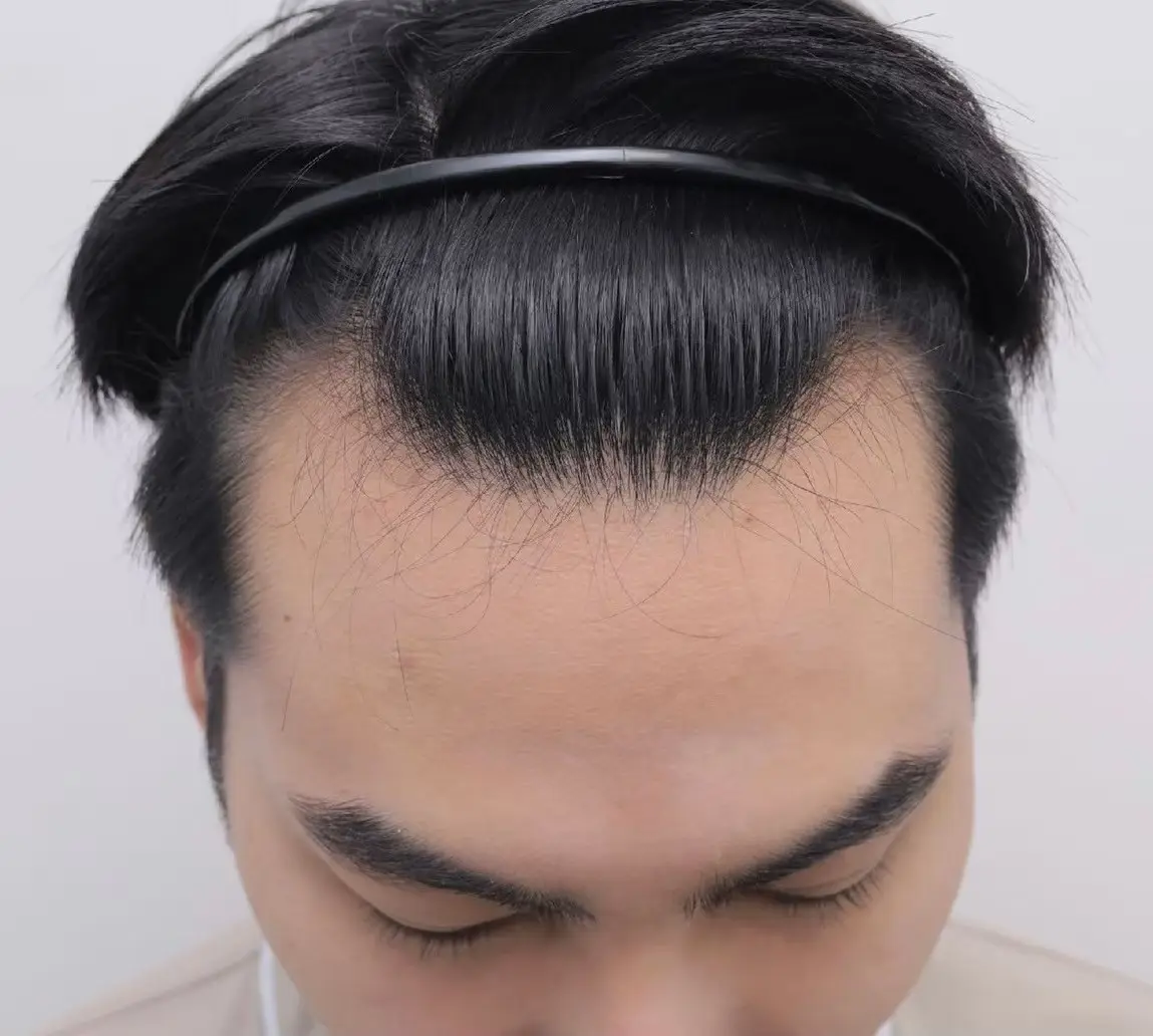 DHI Hair Transplant in Bangkok, Thailand by Wansiri Hospital
