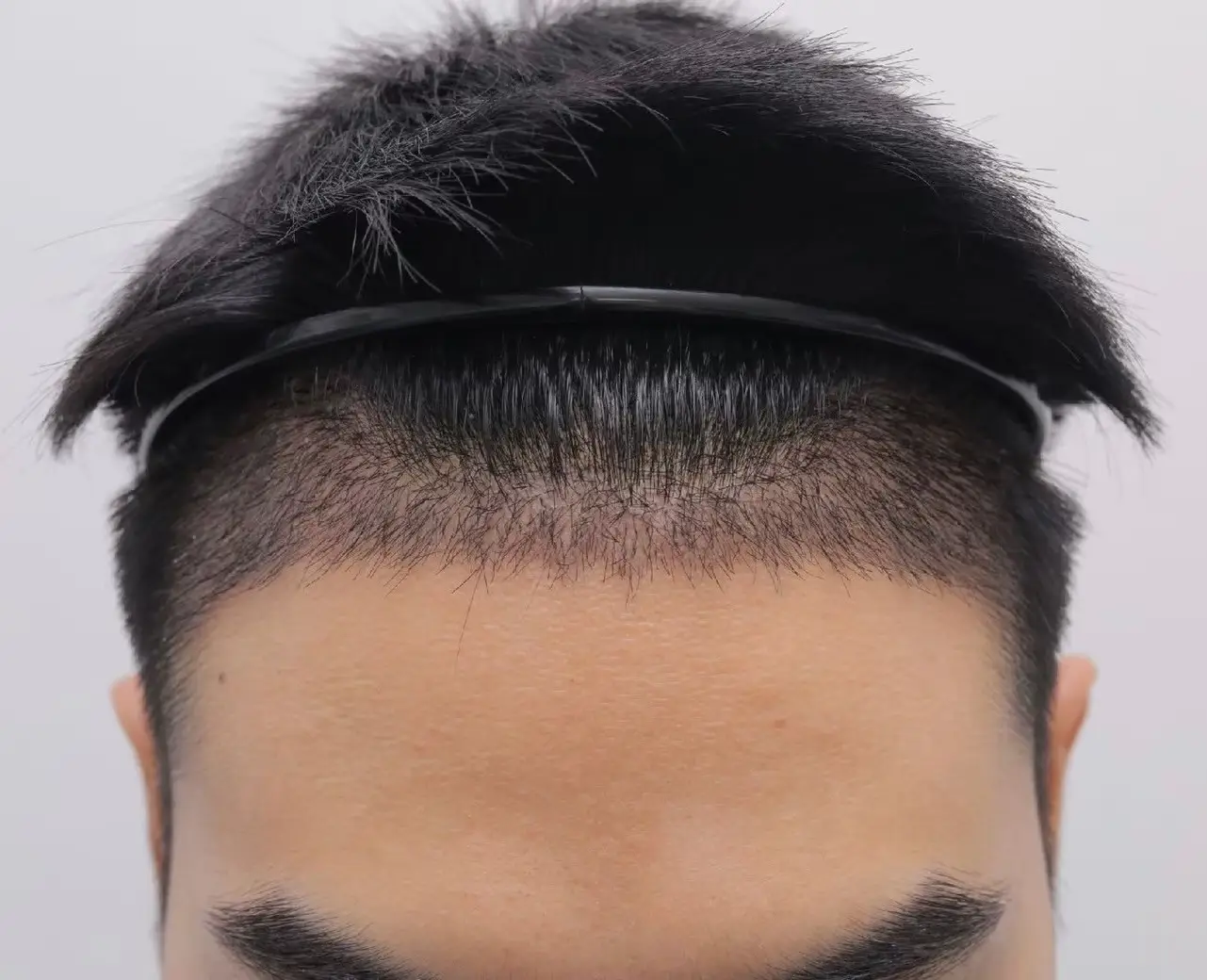 DHI Hair Transplant in Bangkok, Thailand by Wansiri Hospital