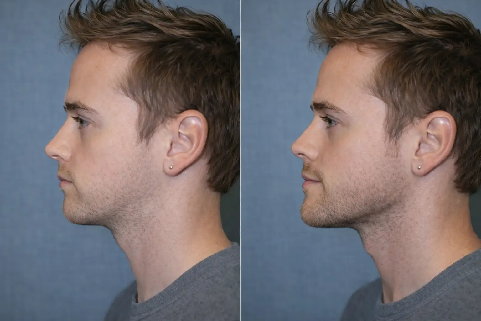 Chin Augmentation in Bangkok, Thailand by Wansiri Hospital