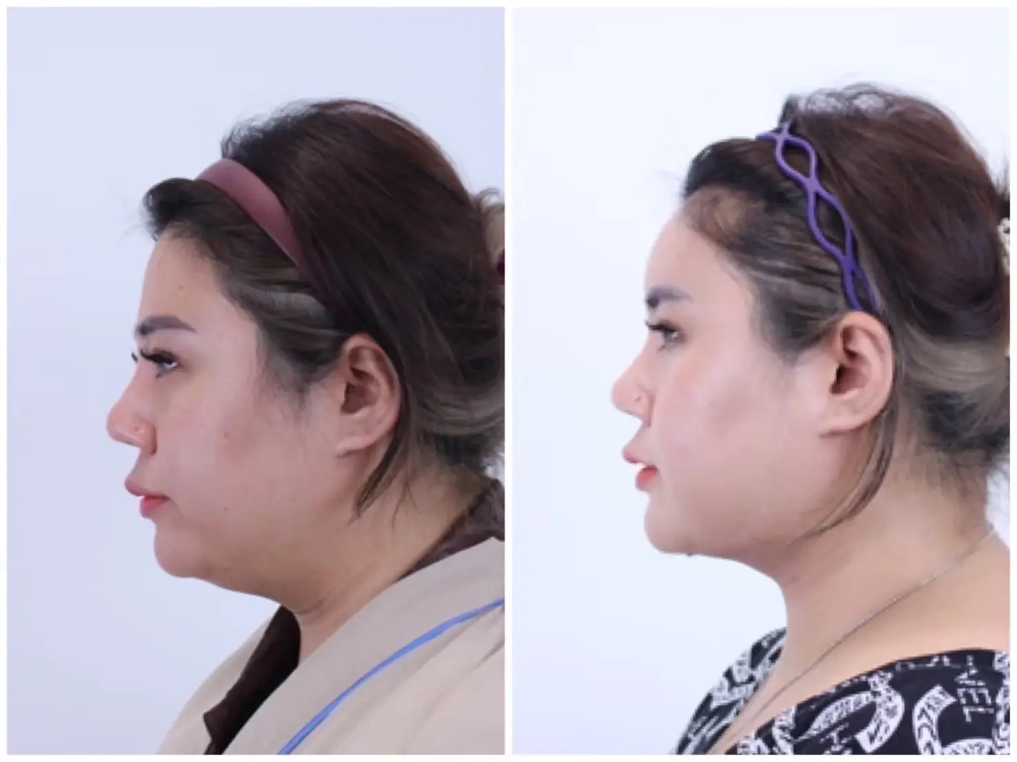 Forehead Silicone Implant in Bangkok, Thailand by Wansiri Hospital — Procedure Gallery Photo