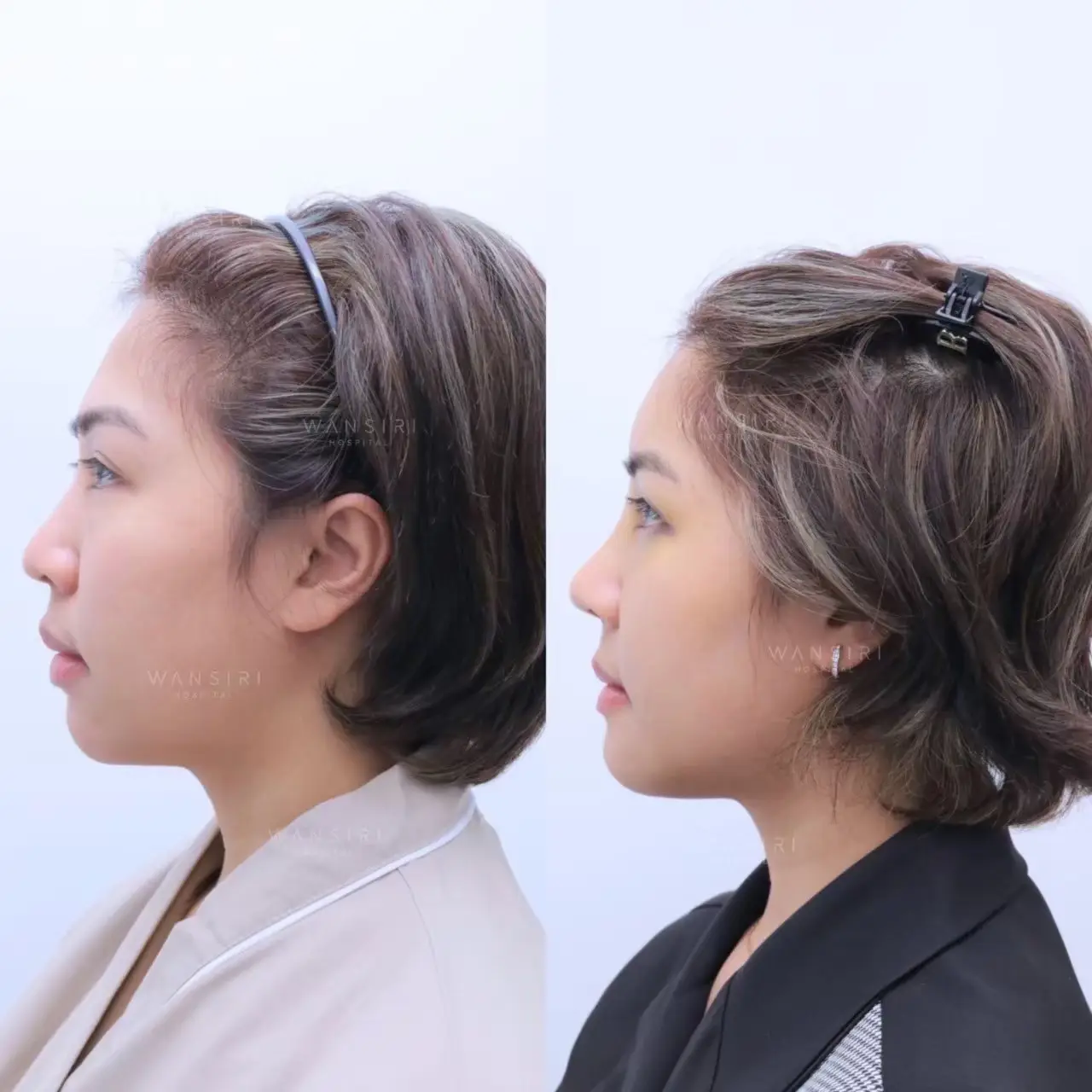 Forehead Silicone Implant in Bangkok, Thailand by Wansiri Hospital — Procedure Gallery Photo