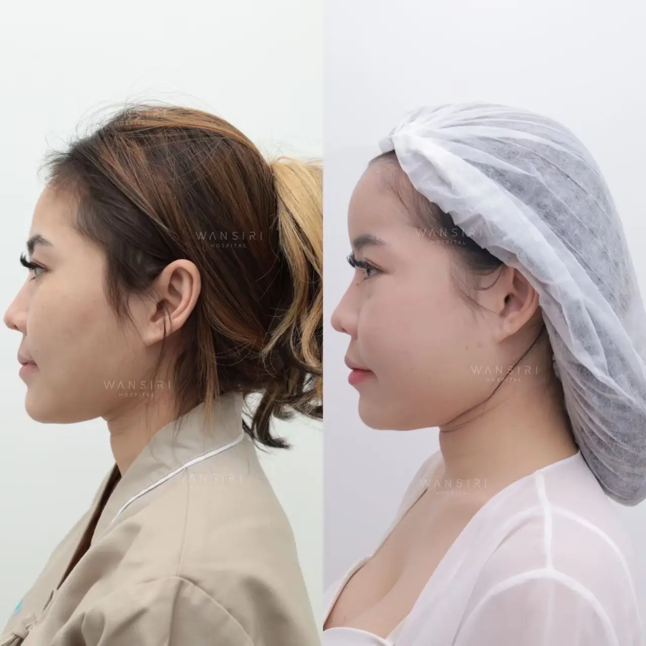 Forehead Silicone Implant in Bangkok, Thailand by Wansiri Hospital — Procedure Gallery Photo