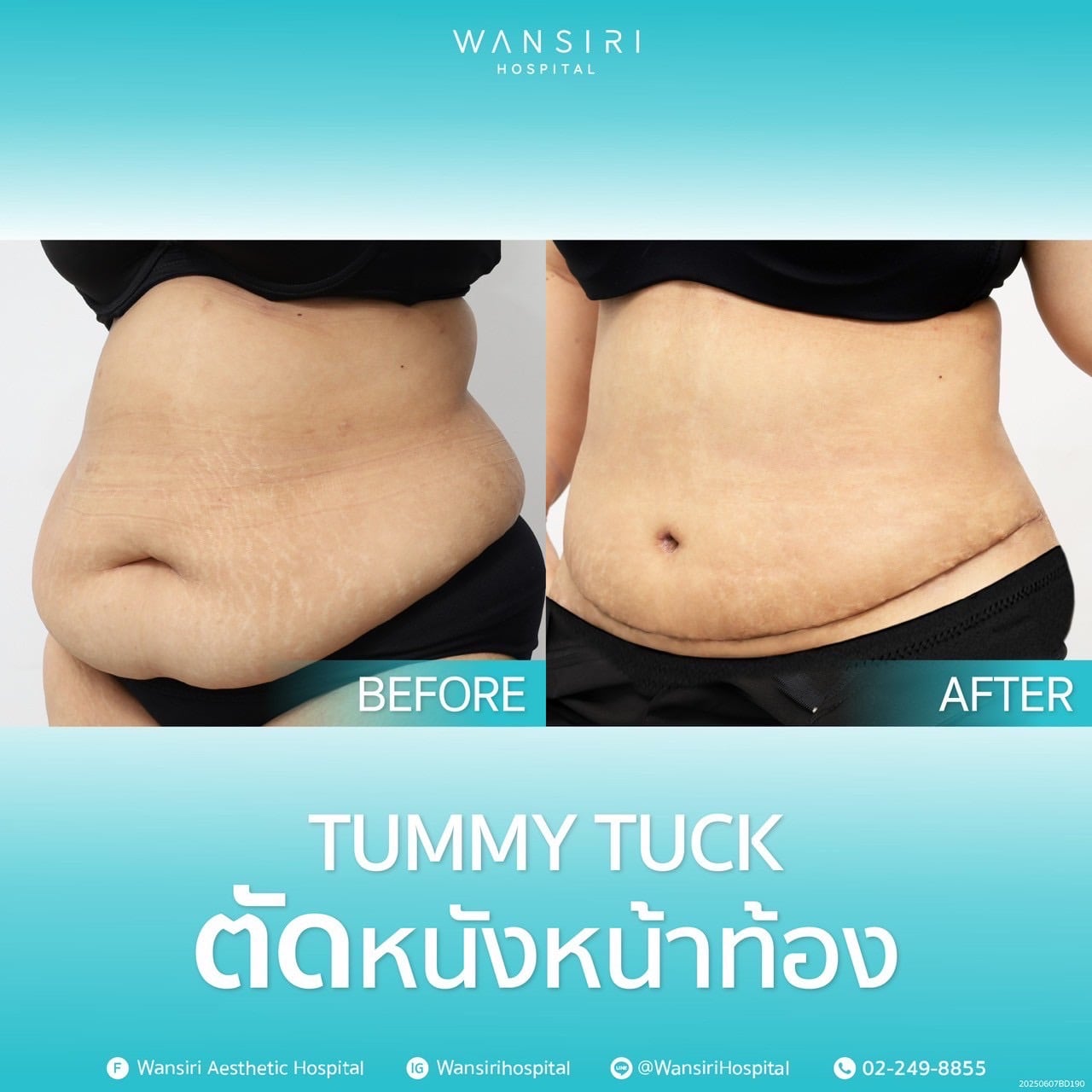 Tummy Tuck in Bangkok, Thailand by Wansiri Hospital