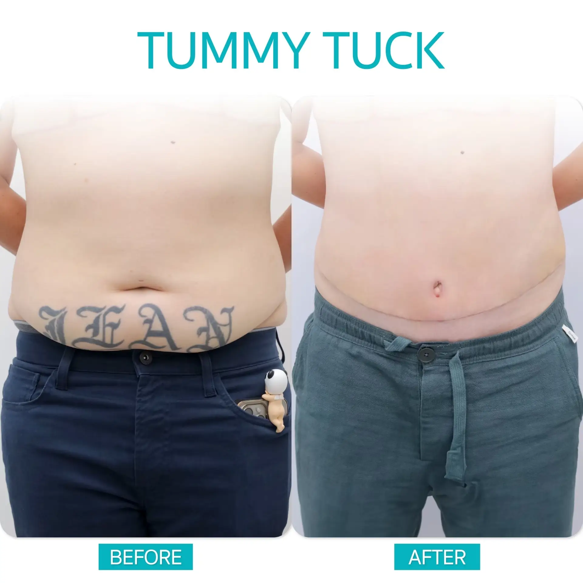 Tummy Tuck in Bangkok, Thailand by Wansiri Hospital