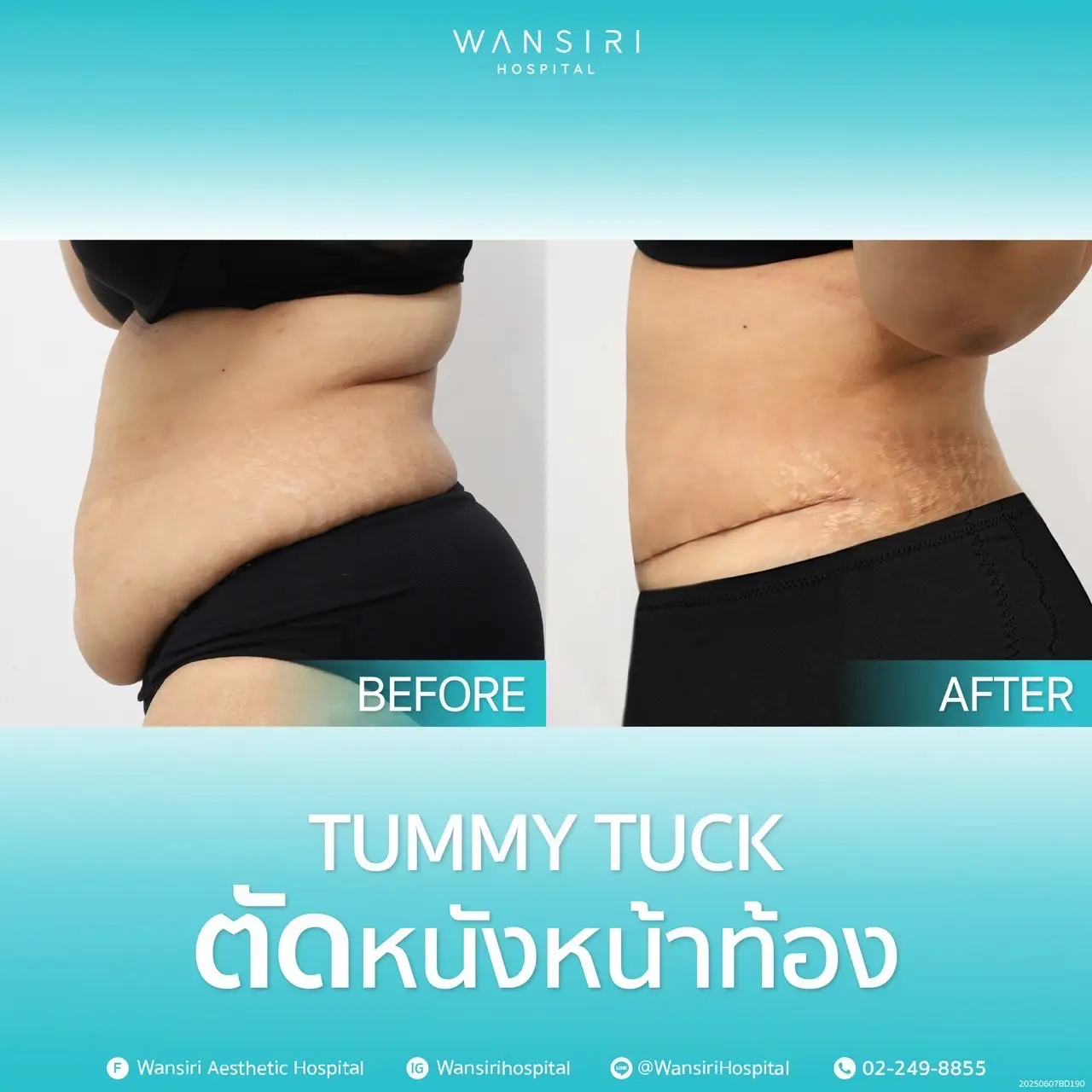 Tummy Tuck in Bangkok, Thailand by Wansiri Hospital