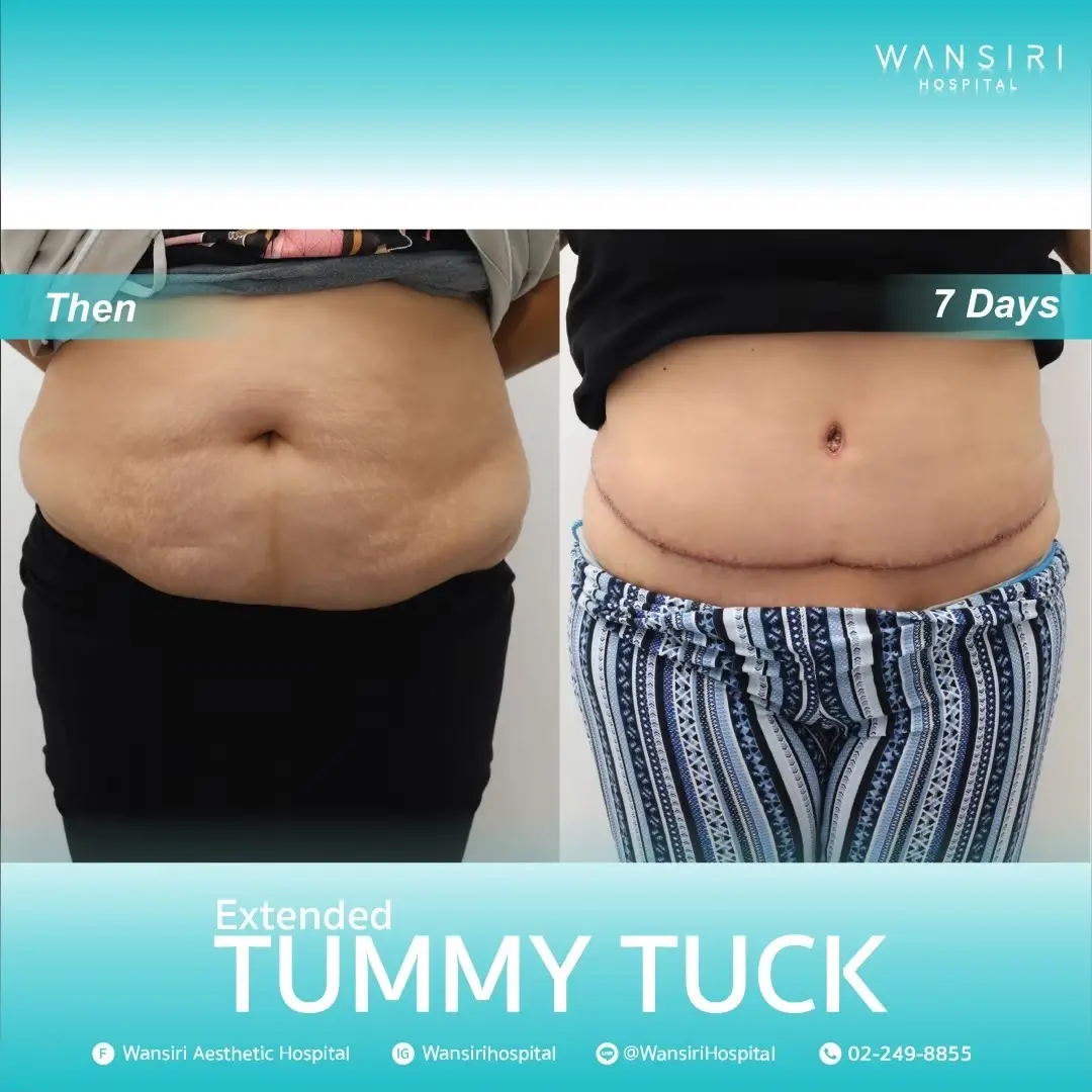 Tummy Tuck in Bangkok, Thailand by Wansiri Hospital