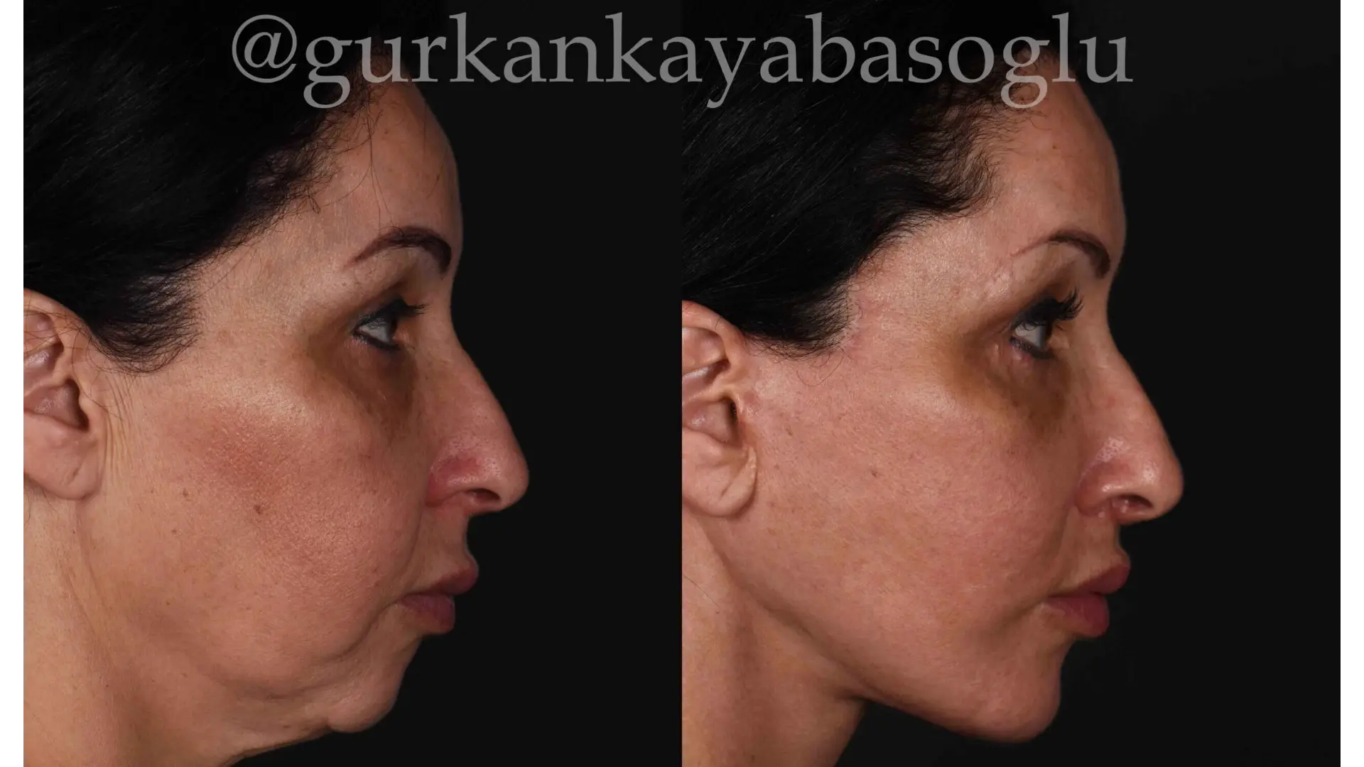 Neck Lift in Istanbul, Turkey by Dr. Gurkan Kayabasoglu
