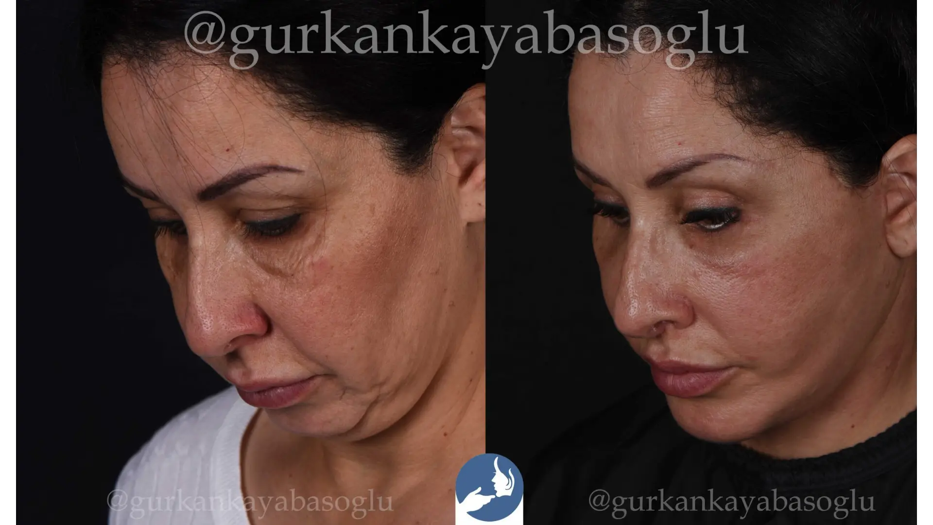 Neck Lift in Istanbul, Turkey by Dr. Gurkan Kayabasoglu