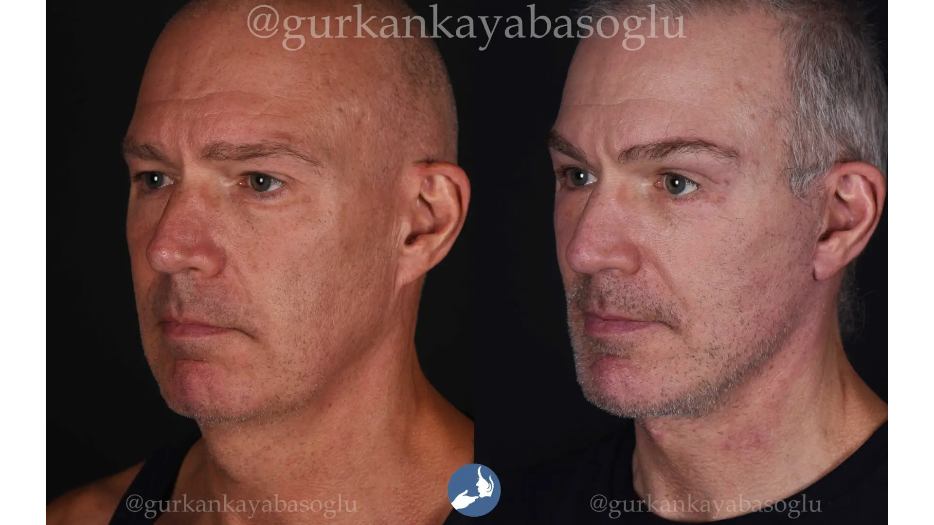Neck Lift in Istanbul, Turkey by Dr. Gurkan Kayabasoglu
