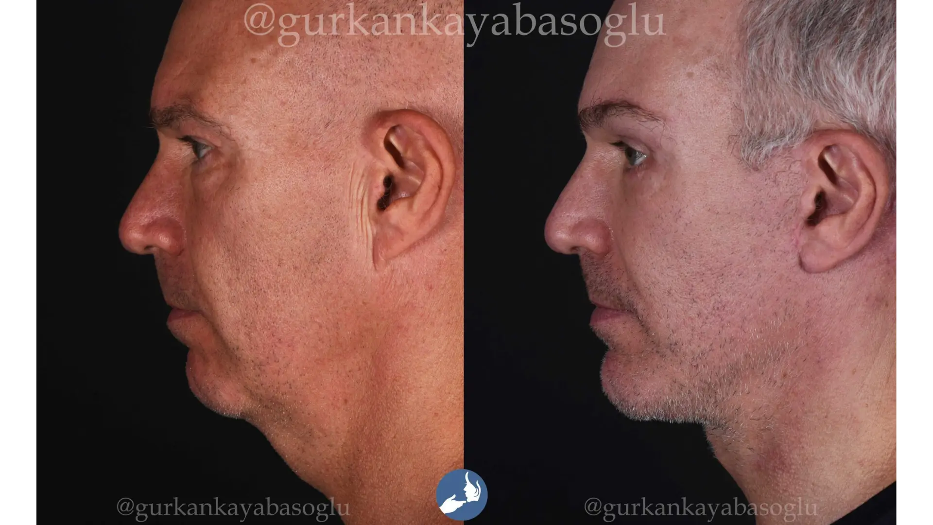 Neck Lift in Istanbul, Turkey by Dr. Gurkan Kayabasoglu