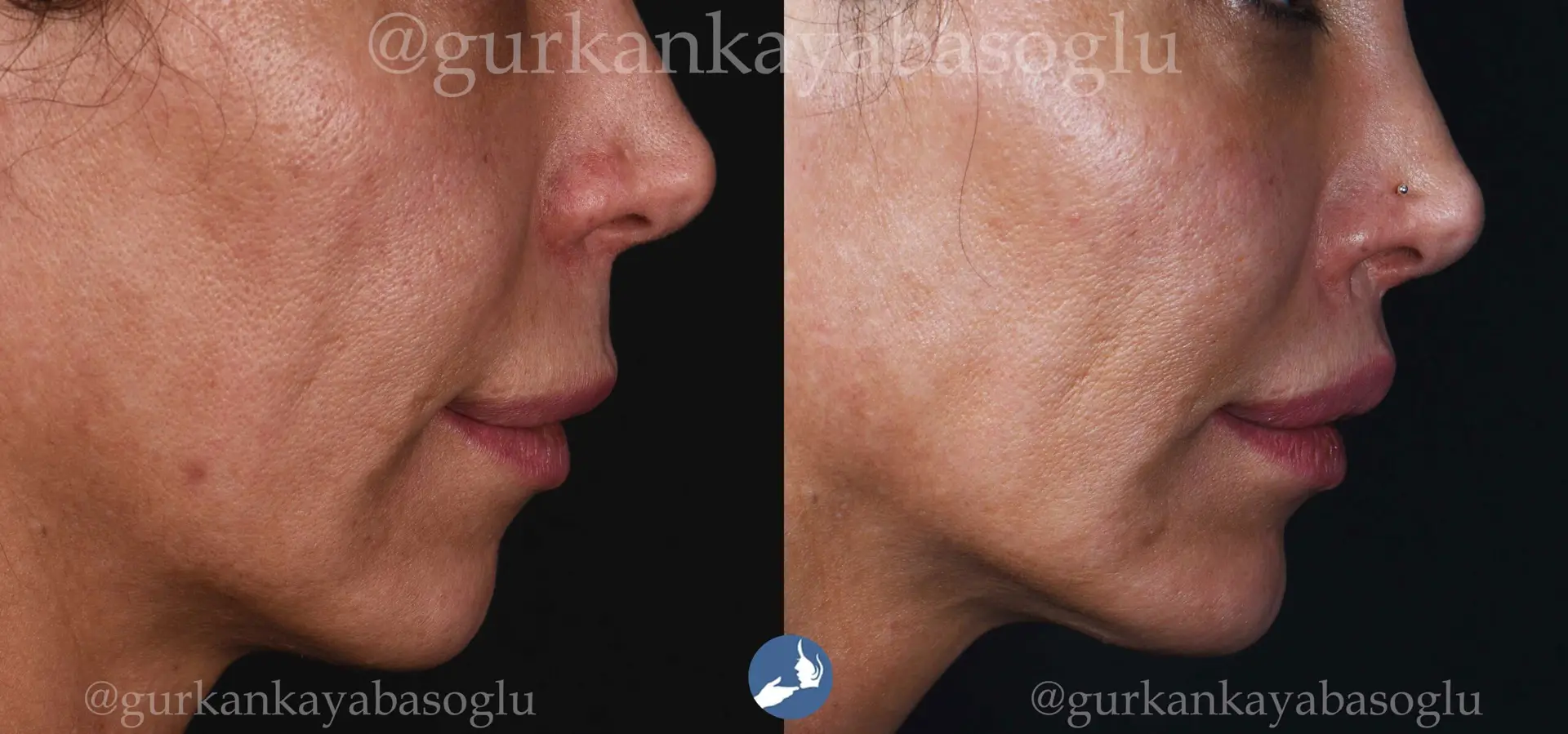 Lip Lift in Istanbul, Turkey by Dr. Gurkan Kayabasoglu
