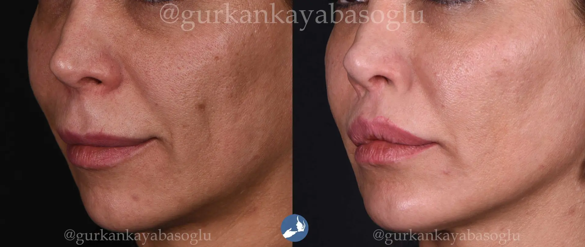 Lip Lift in Istanbul, Turkey by Dr. Gurkan Kayabasoglu