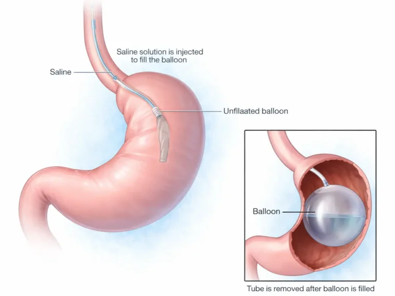 Gastric Balloon in Playa del Carmen, Mexico at CostaMed Medical Group — Weight Loss Surgery Procedure in Mexico