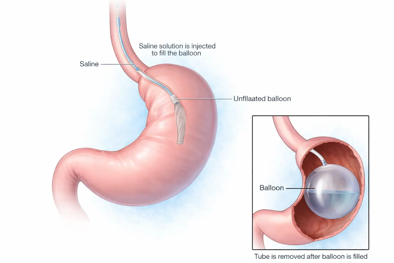 Gastric Balloon in Playa del Carmen, Mexico at CostaMed Medical Group