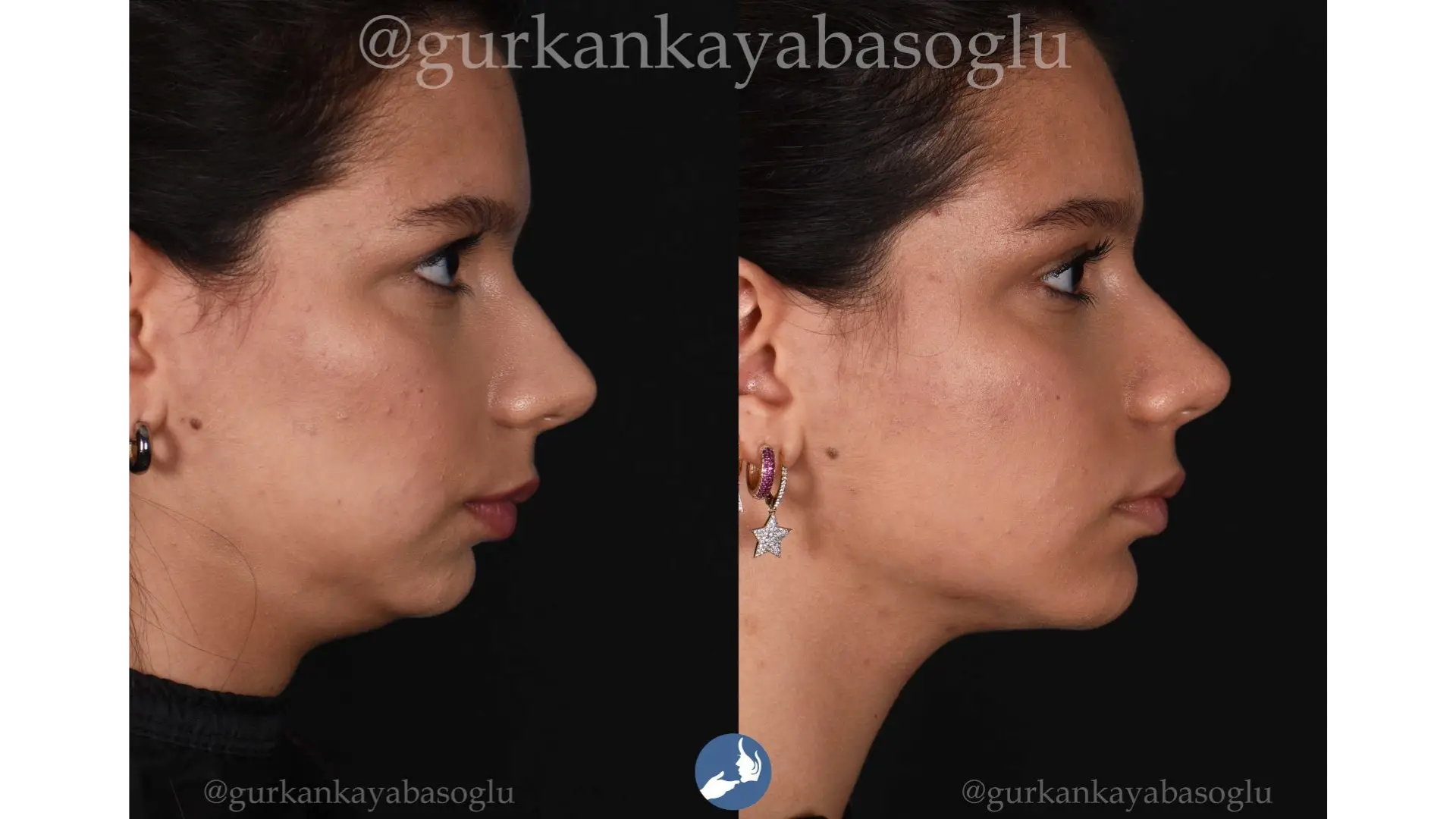 Chin Implant in Istanbul, Turkey by Dr. Gurkan Kayabasoglu