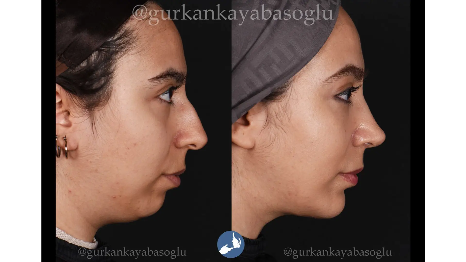 Chin Implant in Istanbul, Turkey by Dr. Gurkan Kayabasoglu