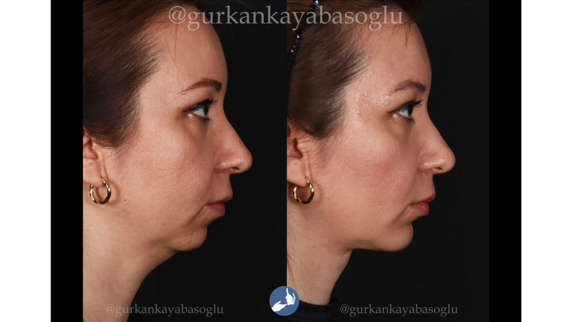 Chin Implant in Istanbul, Turkey by Dr. Gurkan Kayabasoglu
