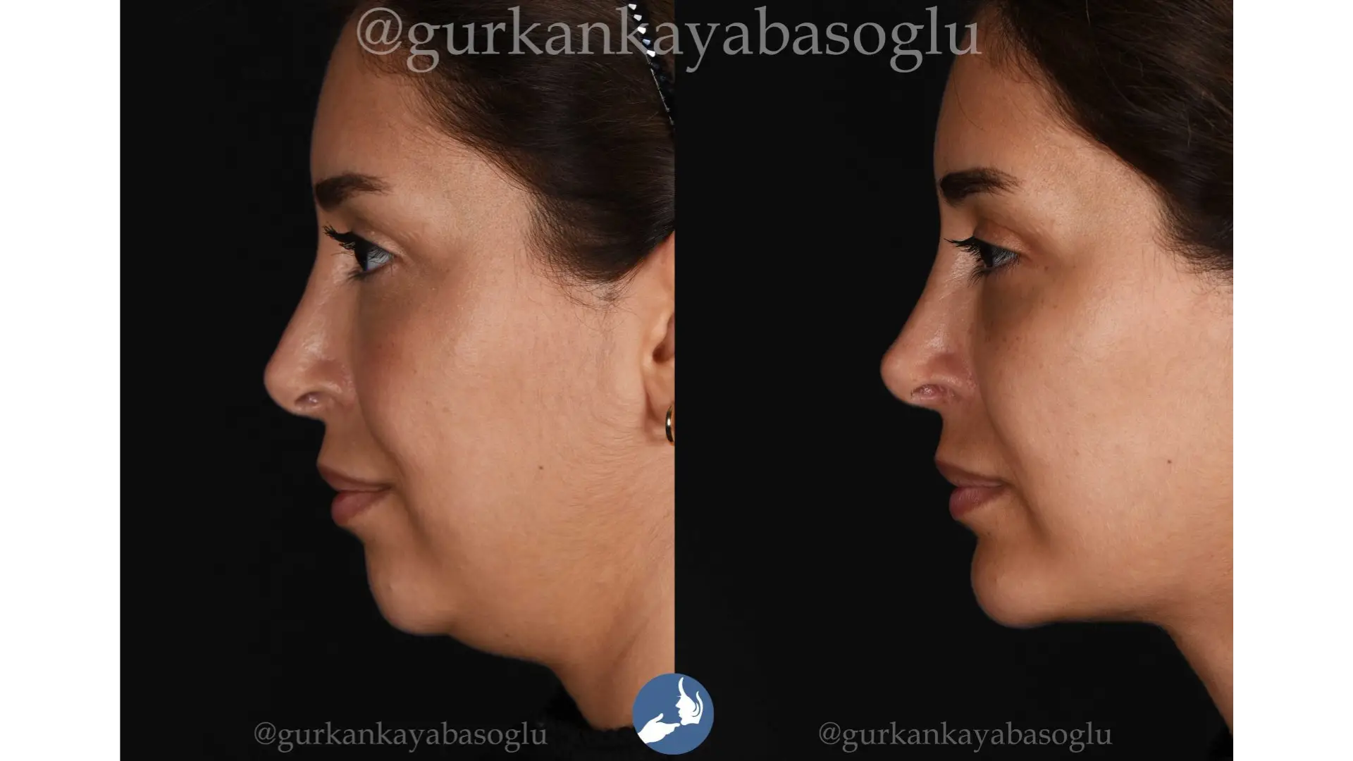 Chin Implant in Istanbul, Turkey by Dr. Gurkan Kayabasoglu