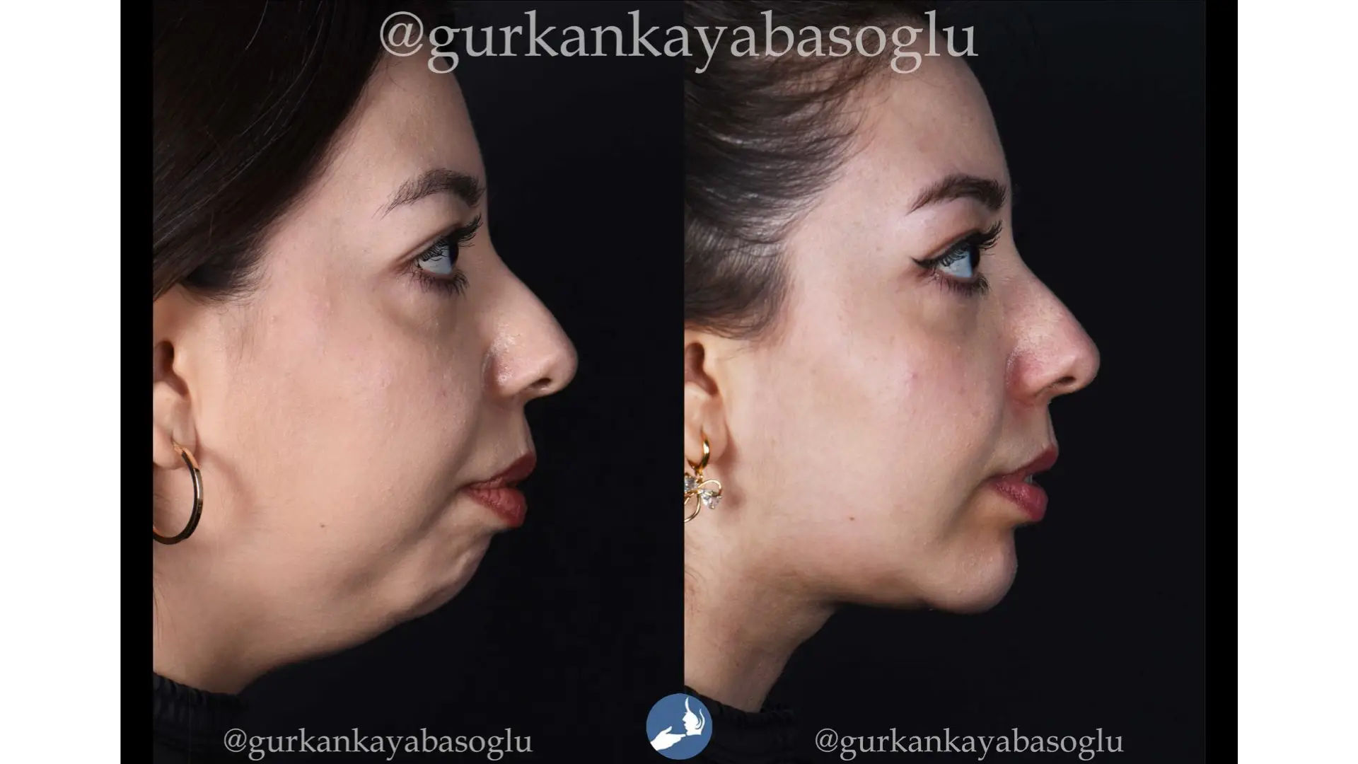 Chin Implant in Istanbul, Turkey by Dr. Gurkan Kayabasoglu