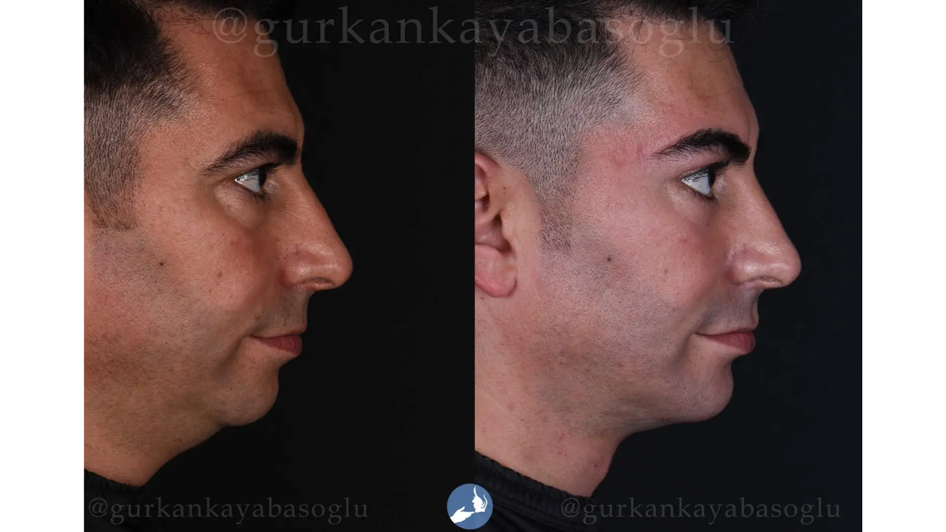 Chin Implant in Istanbul, Turkey by Dr. Gurkan Kayabasoglu