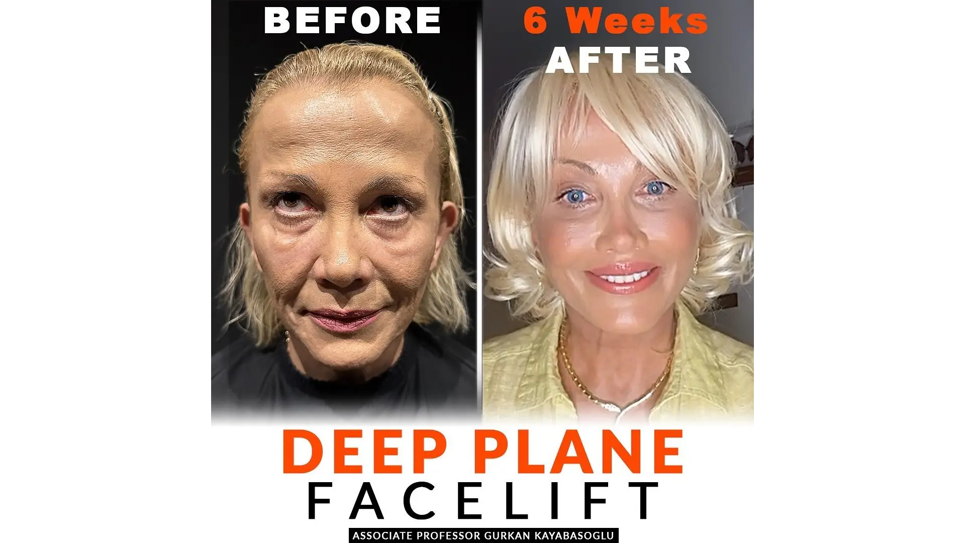 Deep Plane Facelift in Istanbul, Turkey by Dr. Gurkan Kayabasoglu — Procedure Gallery Photo
