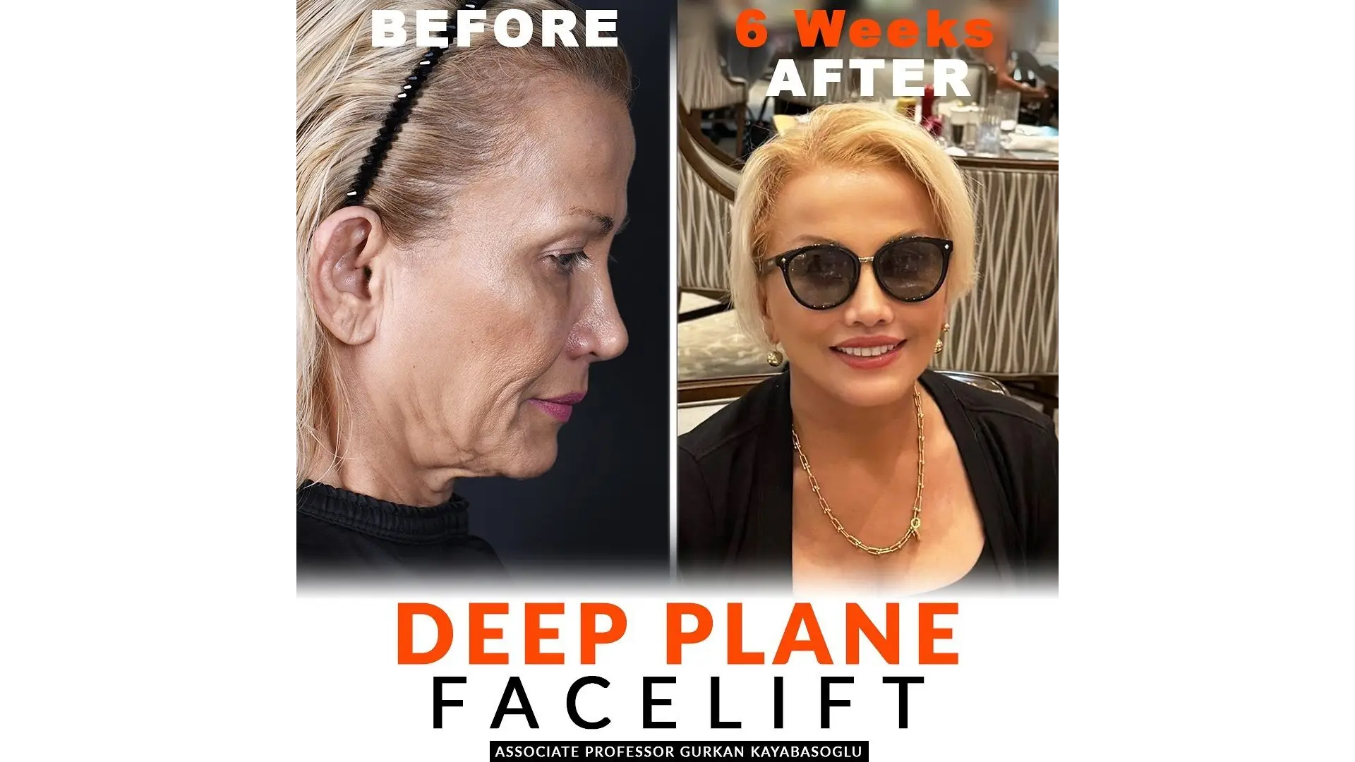 Deep Plane Facelift in Istanbul, Turkey by Dr. Gurkan Kayabasoglu — Procedure Gallery Photo