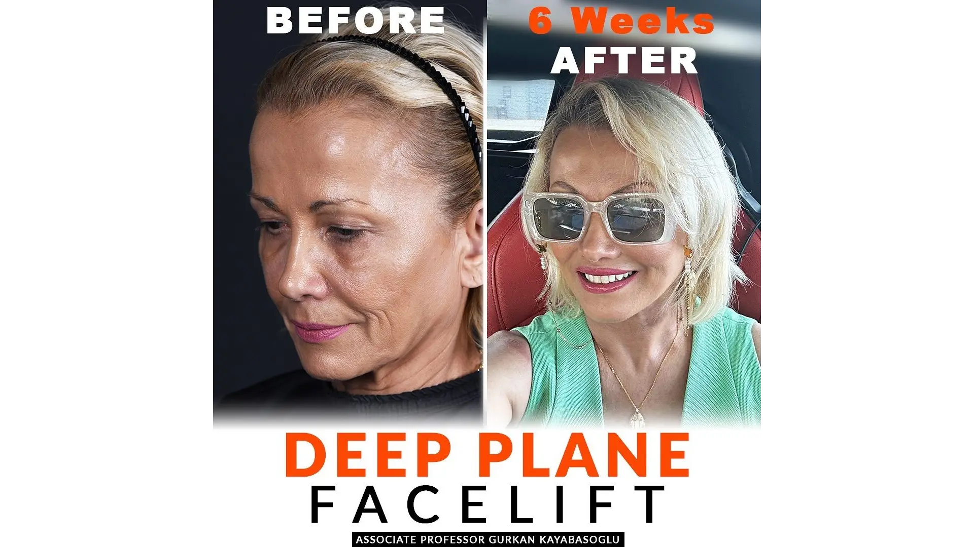 Deep Plane Facelift in Istanbul, Turkey by Dr. Gurkan Kayabasoglu — Procedure Gallery Photo