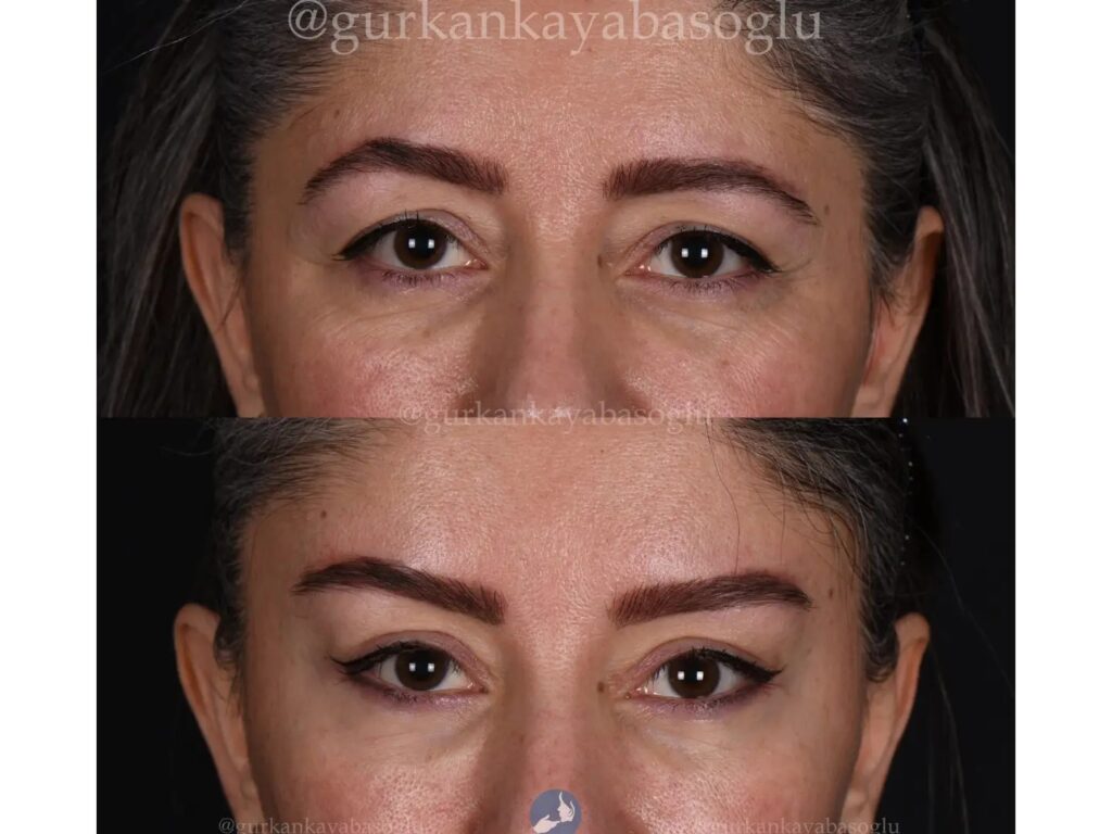Eyelid Surgery (Blepharoplasty) in Istanbul, Turkey by Dr. Gurkan Kayabasoglu — Plastic Surgery Procedure in Turkey