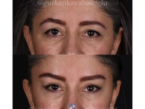 Eyelid Surgery (Blepharoplasty) in Istanbul, Turkey by Dr. Gurkan Kayabasoglu — Plastic Surgery in Turkey