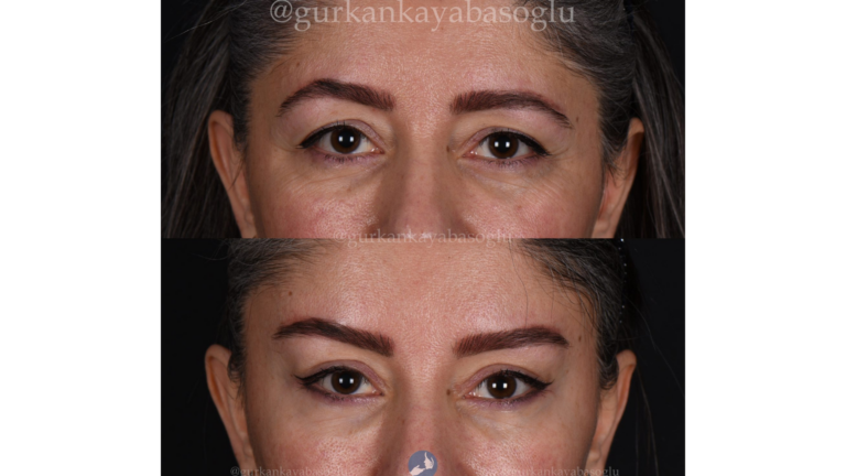 Eyelid Surgery (Blepharoplasty) in Istanbul, Turkey by Dr. Gurkan Kayabasoglu