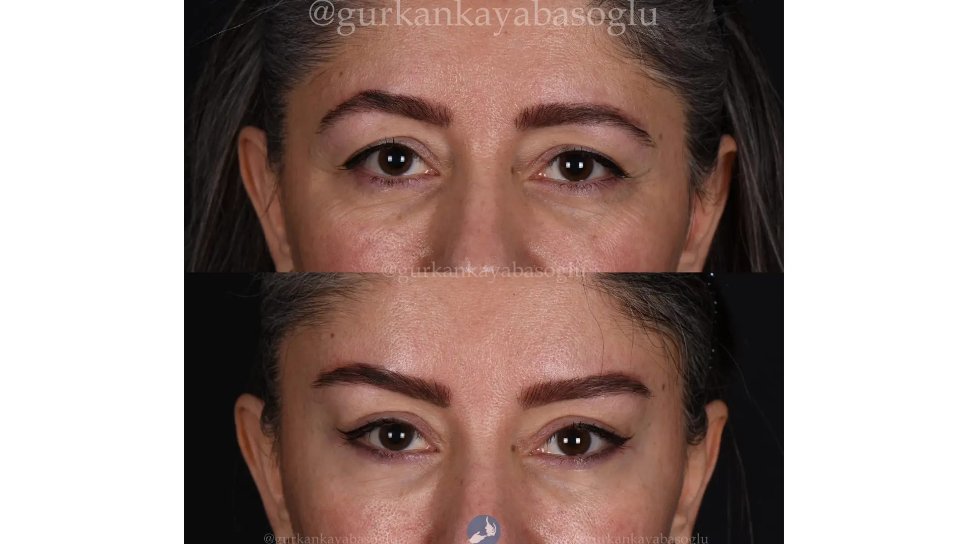 Eyelid Surgery (Blepharoplasty) in Istanbul, Turkey by Dr. Gurkan Kayabasoglu — Procedure Gallery Photo