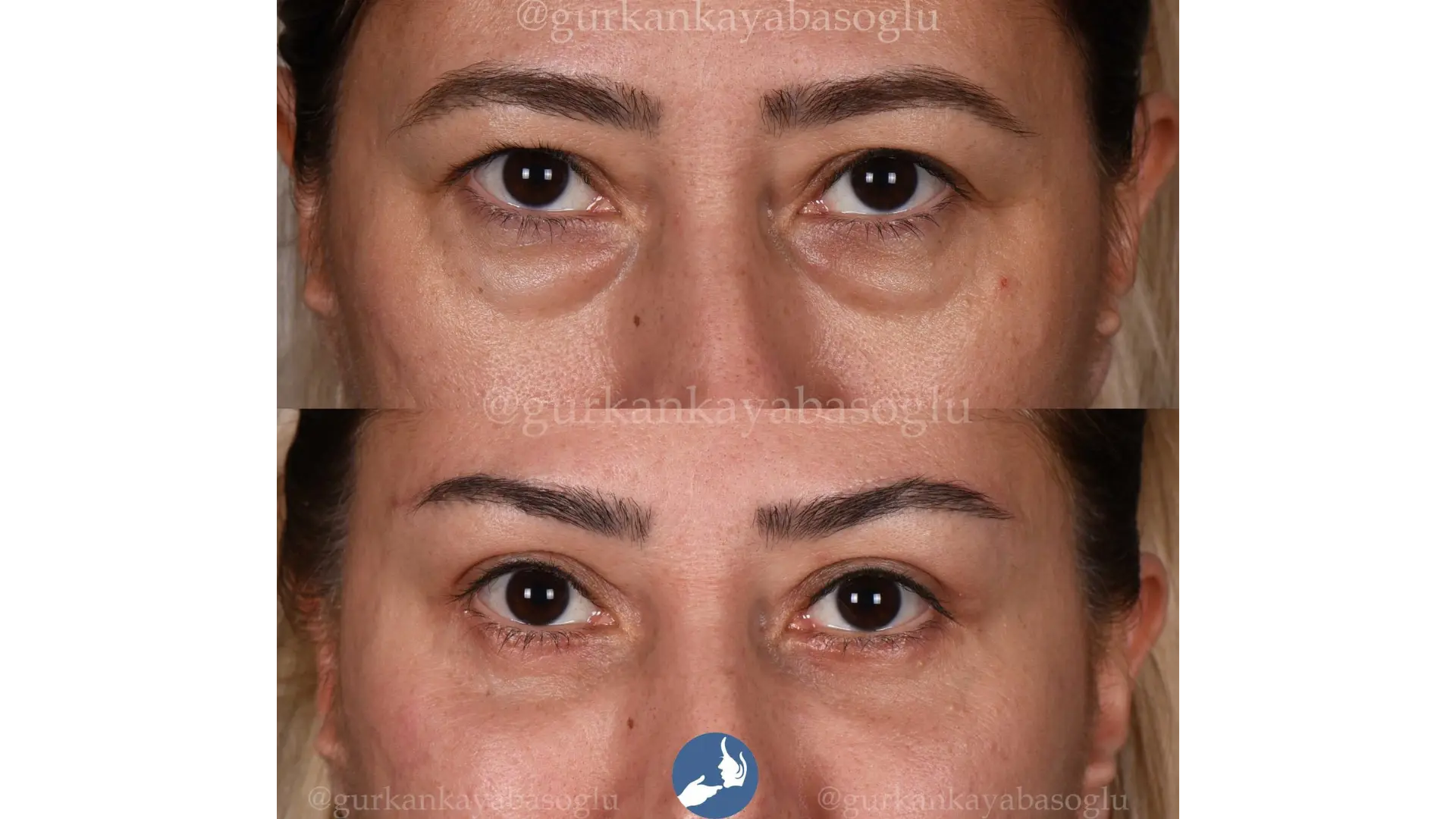 Eyelid Surgery (Blepharoplasty) in Istanbul, Turkey by Dr. Gurkan Kayabasoglu — Procedure Gallery Photo