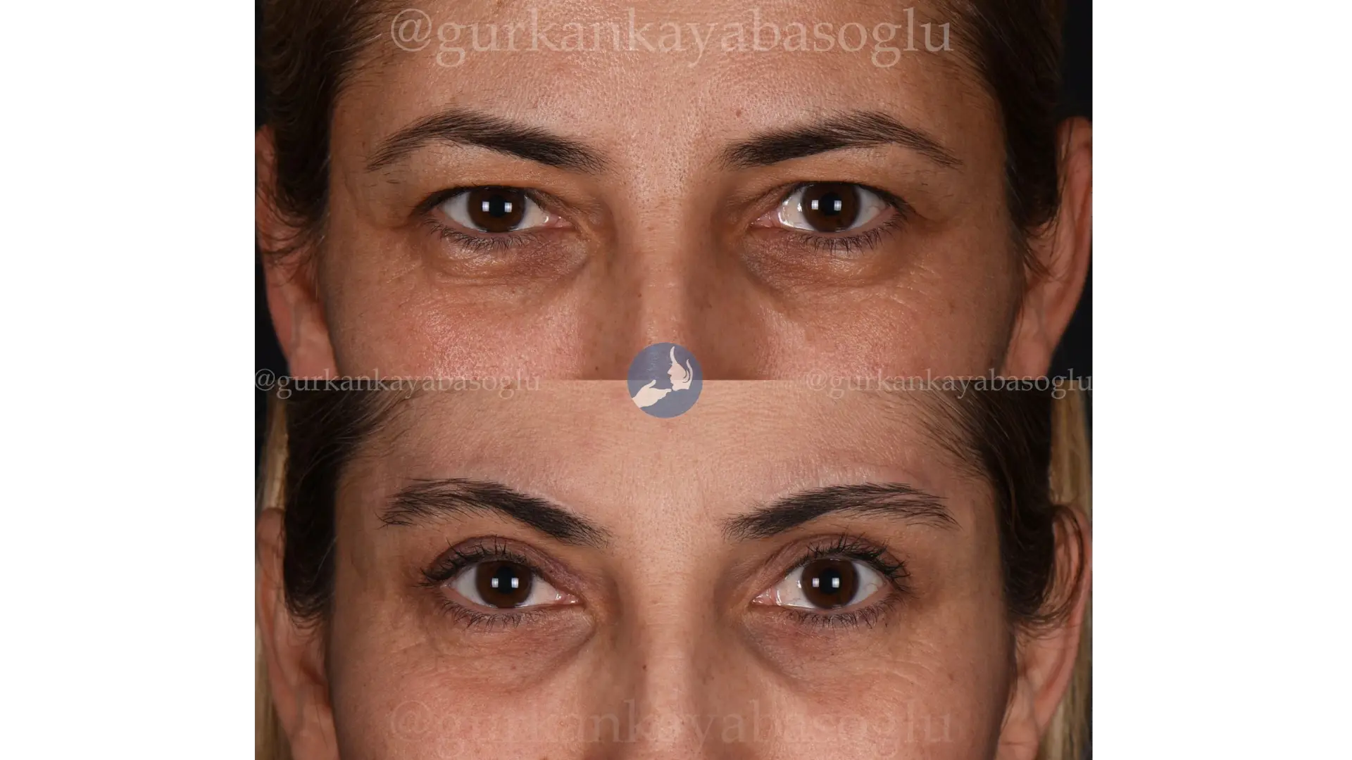 Eyelid Surgery (Blepharoplasty) in Istanbul, Turkey by Dr. Gurkan Kayabasoglu — Procedure Gallery Photo