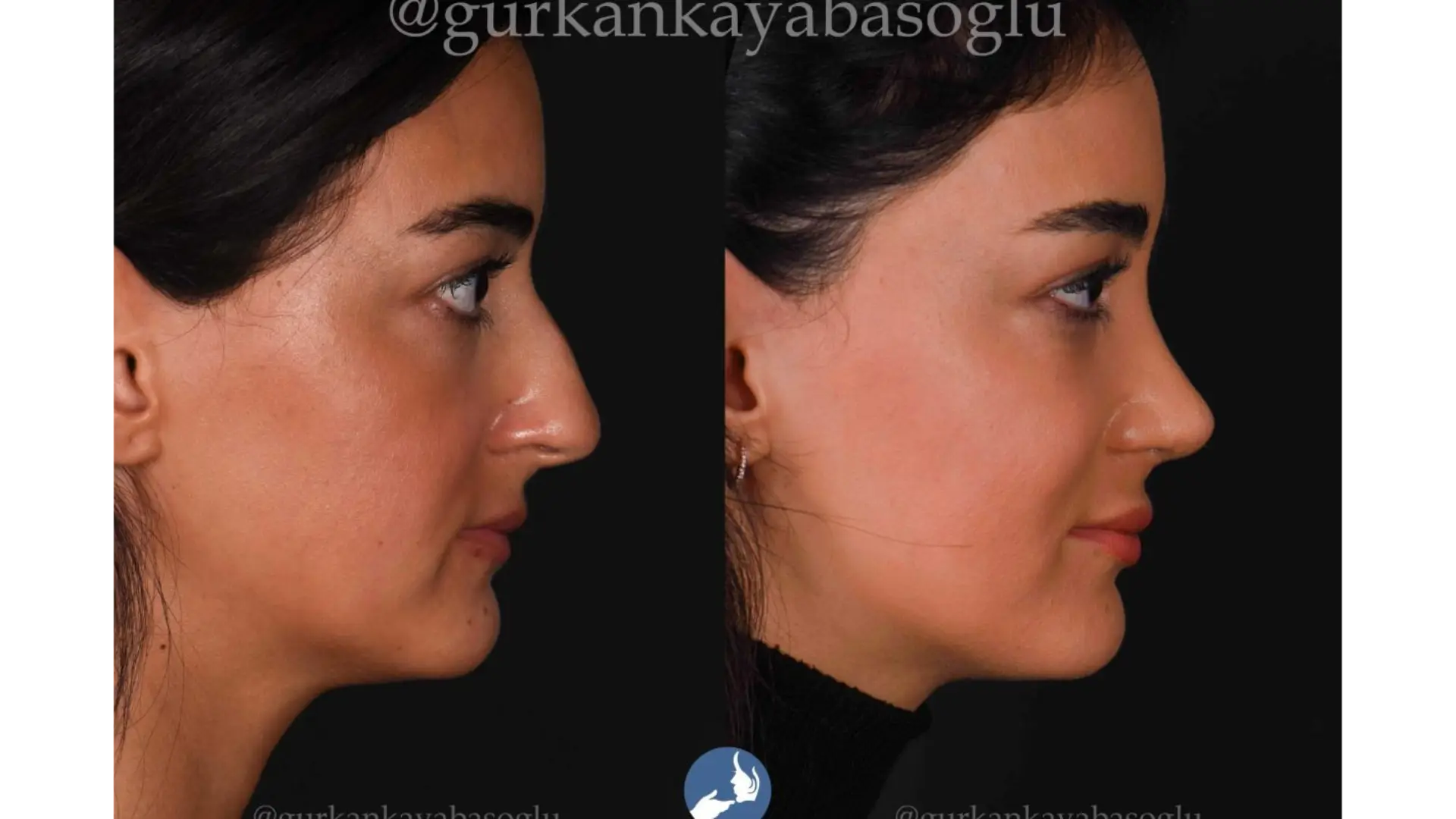Rhinoplasty, Revision, Ultrasonic, Closed & Ethnic Rhinoplasty in Istanbul, Turkey by Dr. Gurkan Kayabasoglu