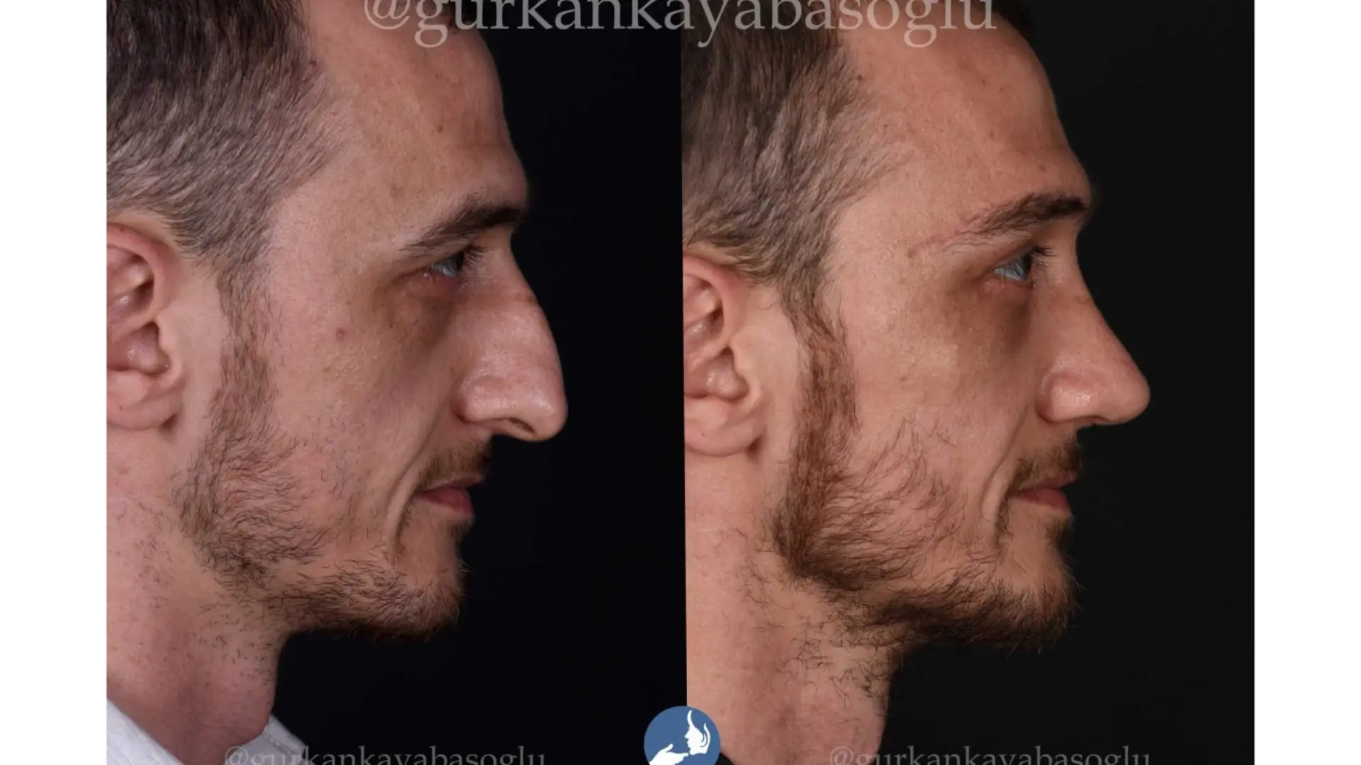 Rhinoplasty, Revision, Ultrasonic, Closed & Ethnic Rhinoplasty in Istanbul, Turkey by Dr. Gurkan Kayabasoglu