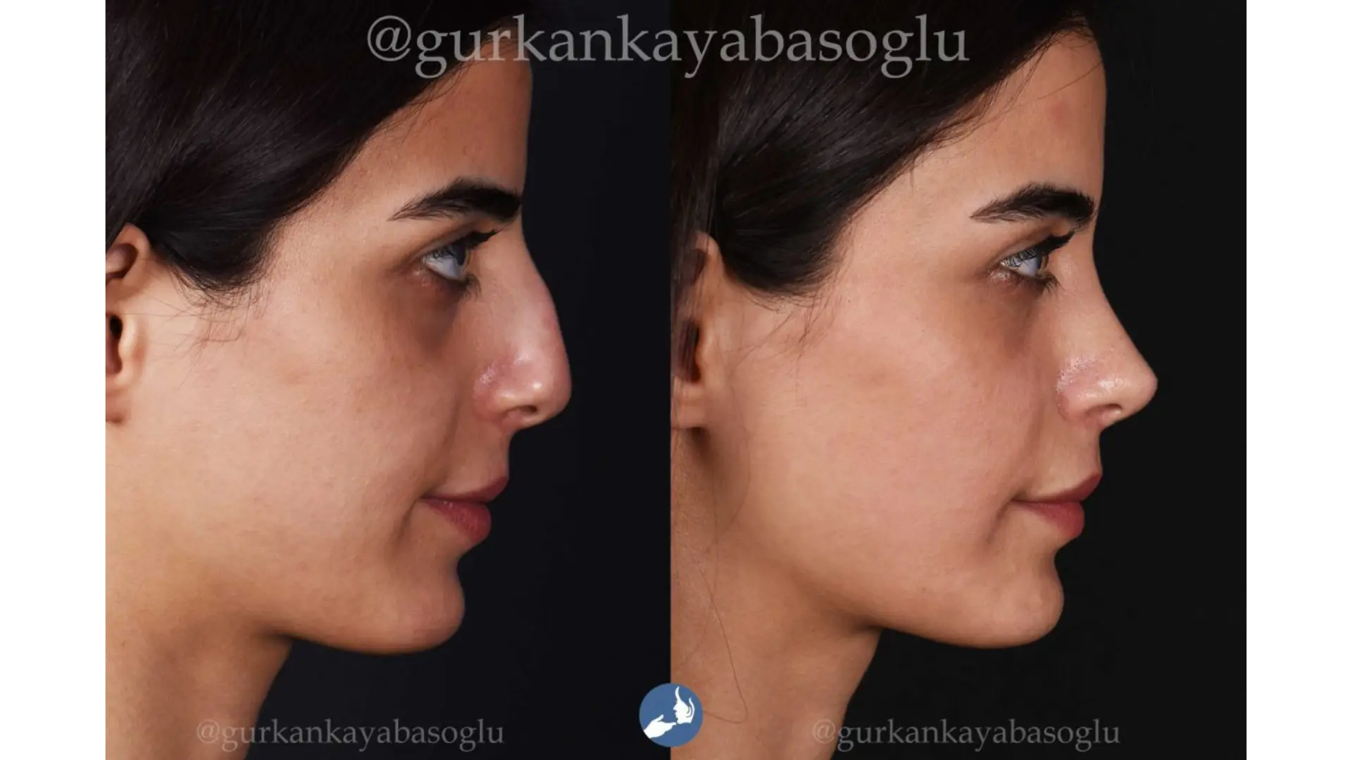 Rhinoplasty, Revision, Ultrasonic, Closed & Ethnic Rhinoplasty in Istanbul, Turkey by Dr. Gurkan Kayabasoglu