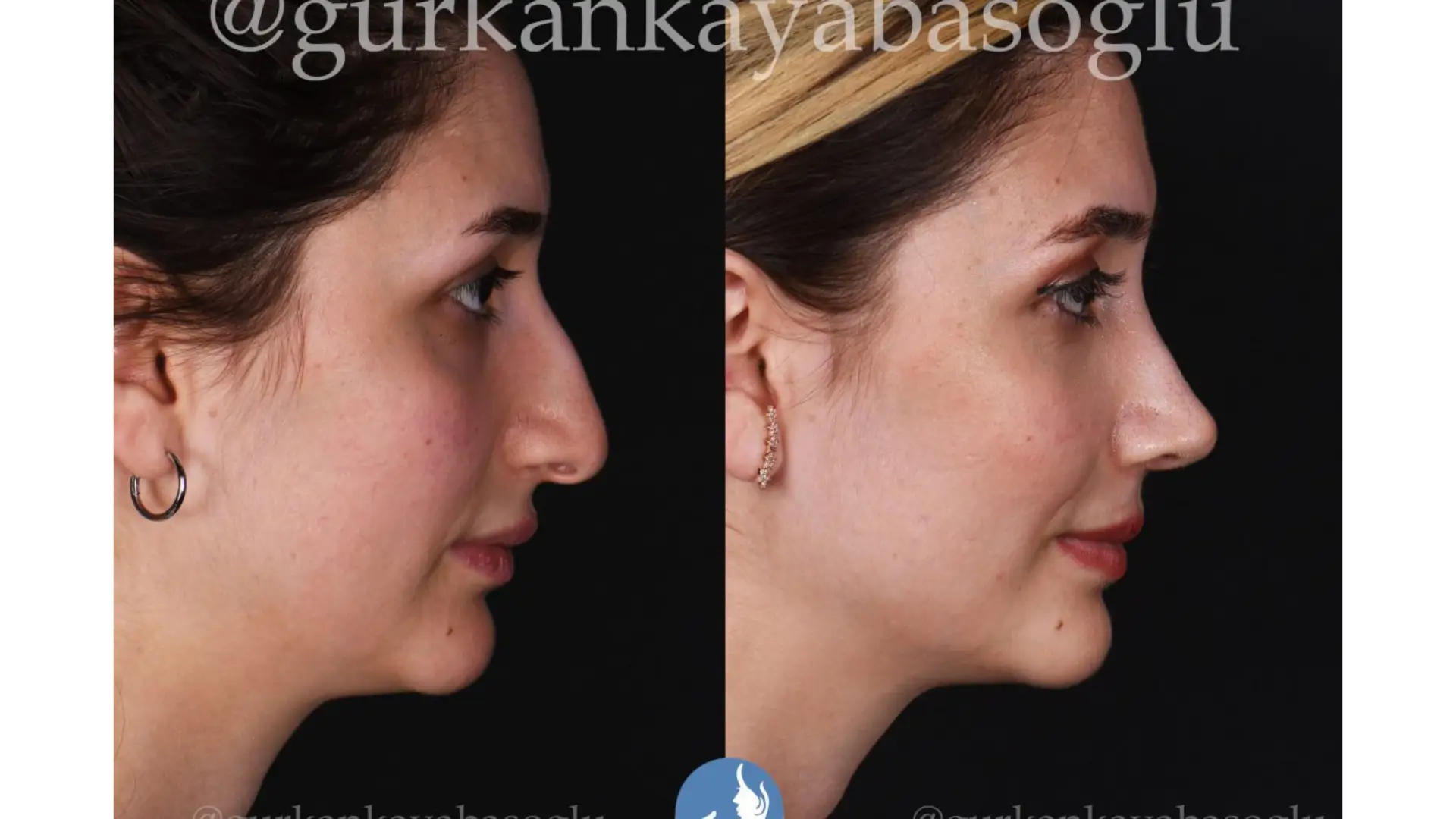 Rhinoplasty, Revision, Ultrasonic, Closed & Ethnic Rhinoplasty in Istanbul, Turkey by Dr. Gurkan Kayabasoglu