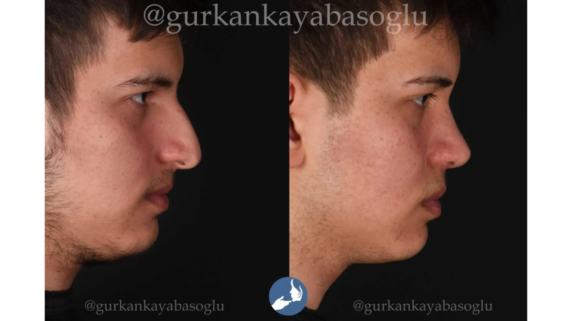 Rhinoplasty, Revision, Ultrasonic, Closed & Ethnic Rhinoplasty in Istanbul, Turkey by Dr. Gurkan Kayabasoglu