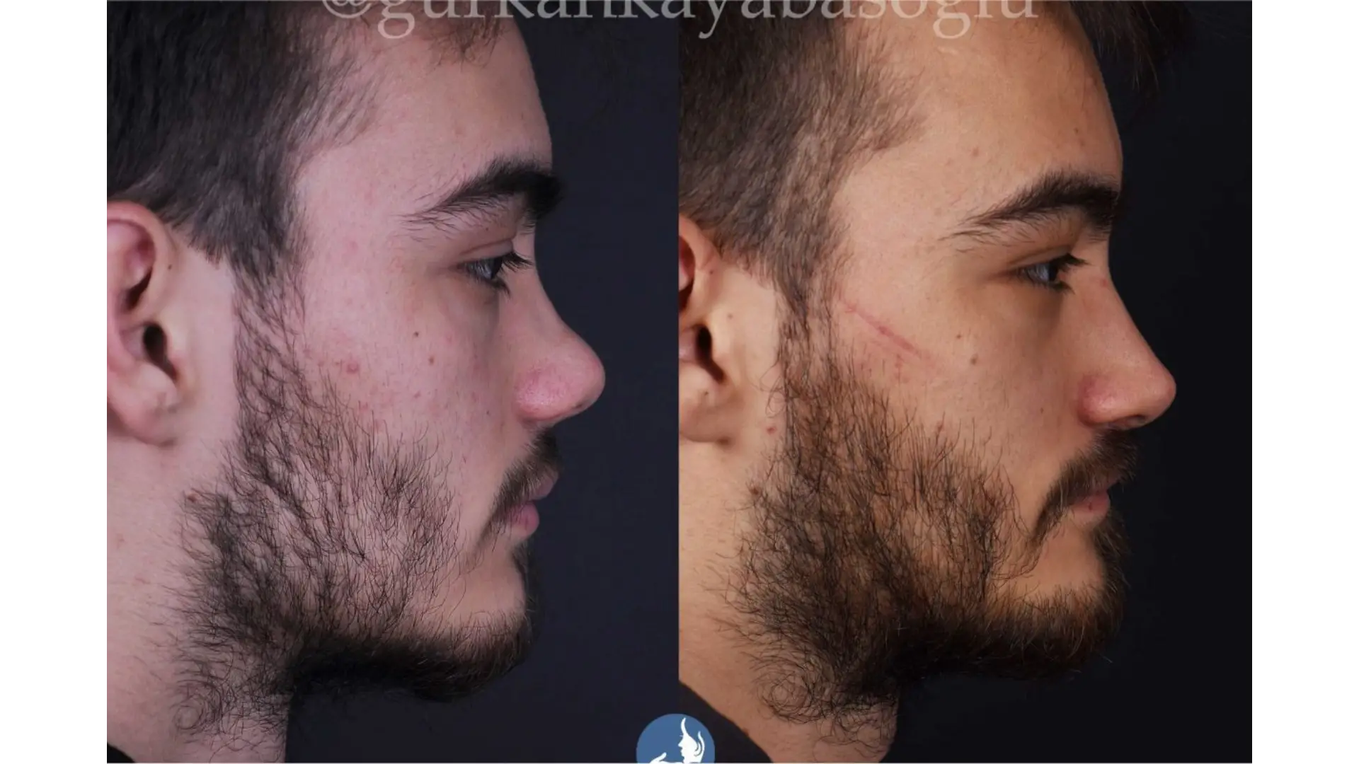 Rhinoplasty, Revision, Ultrasonic, Closed & Ethnic Rhinoplasty in Istanbul, Turkey by Dr. Gurkan Kayabasoglu