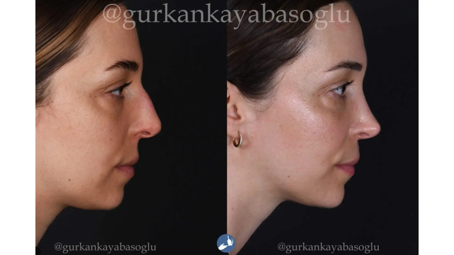 Rhinoplasty, Revision, Ultrasonic, Closed & Ethnic Rhinoplasty in Istanbul, Turkey by Dr. Gurkan Kayabasoglu