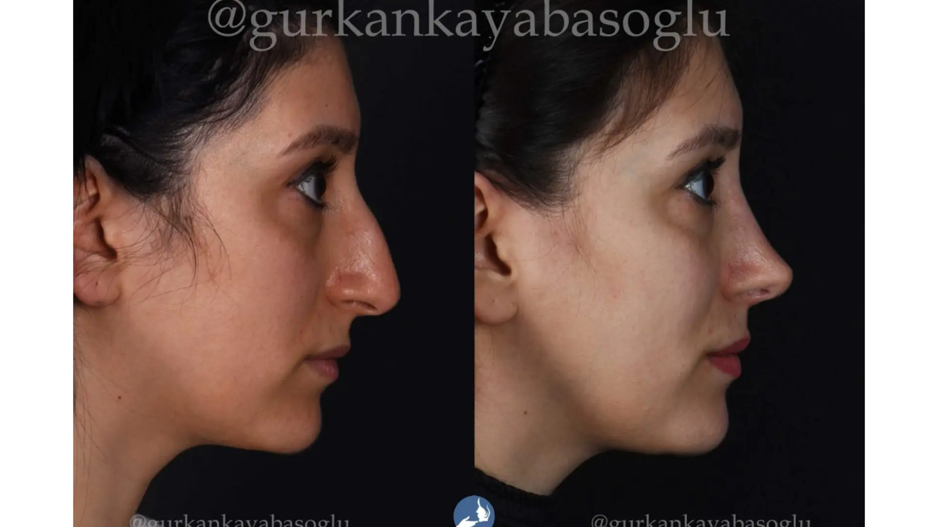 Rhinoplasty, Revision, Ultrasonic, Closed & Ethnic Rhinoplasty in Istanbul, Turkey by Dr. Gurkan Kayabasoglu